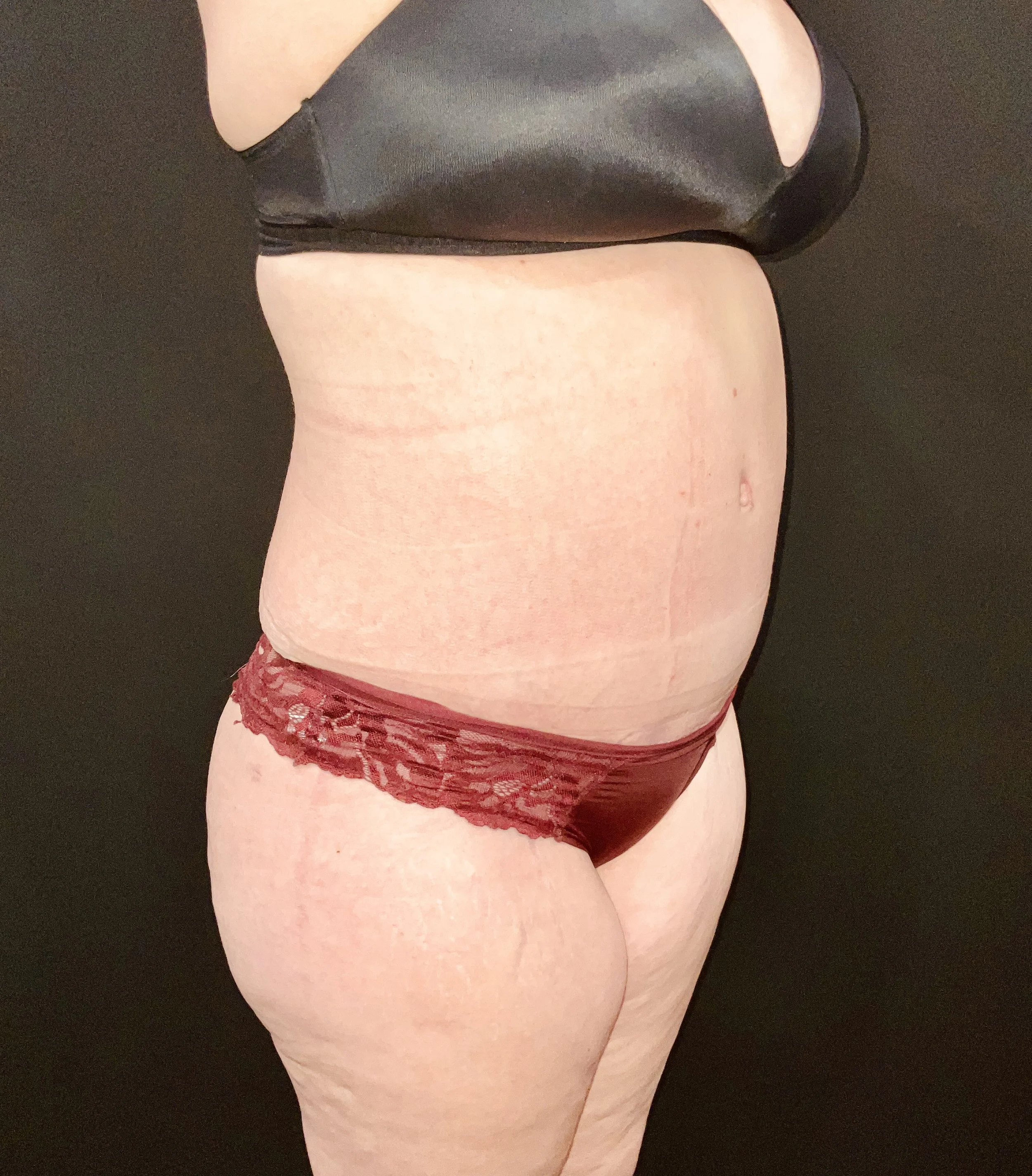 Abdominoplasty (Tummy Tuck) before and after - after