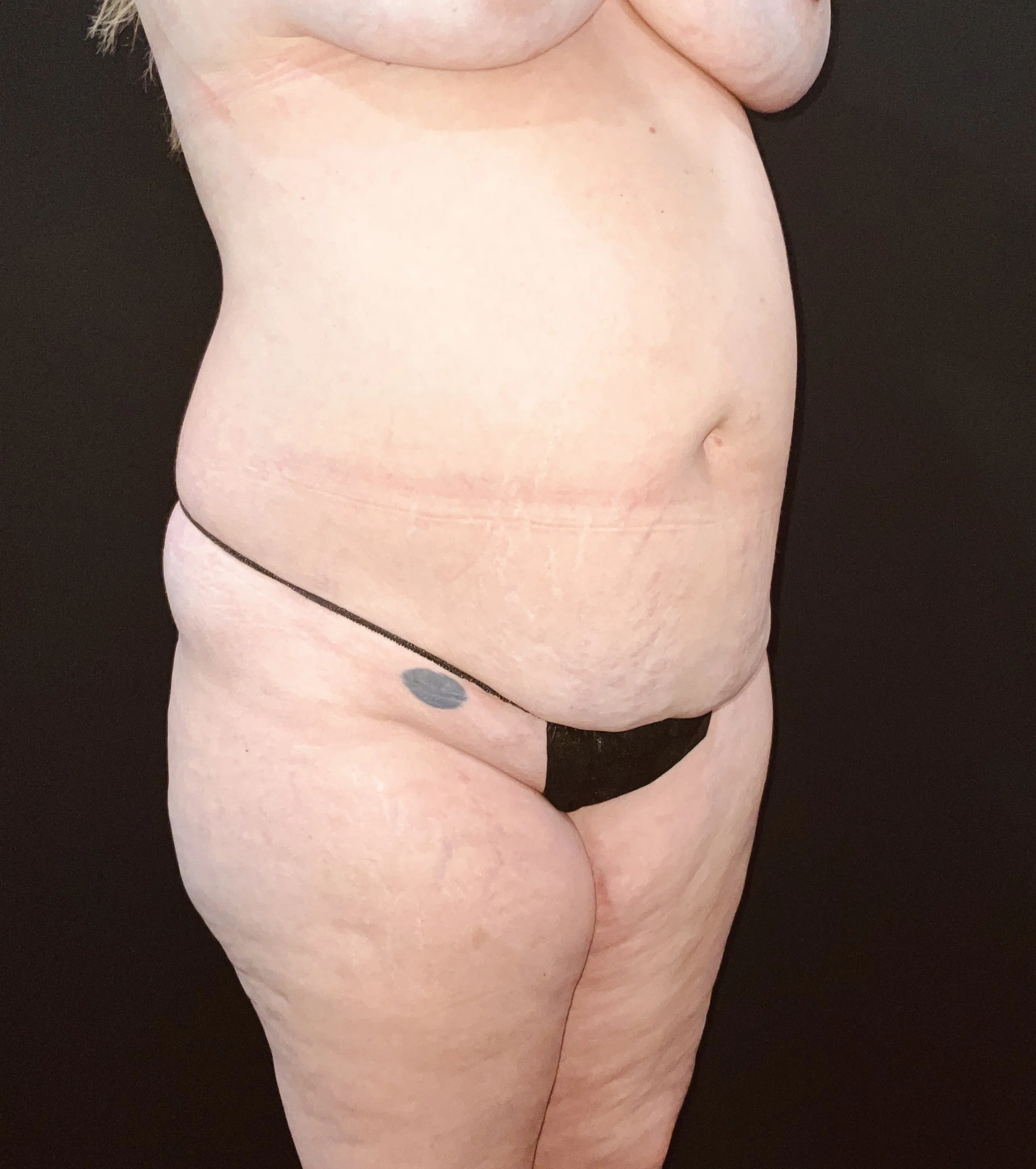 Abdominoplasty (Tummy Tuck) before and after - before
