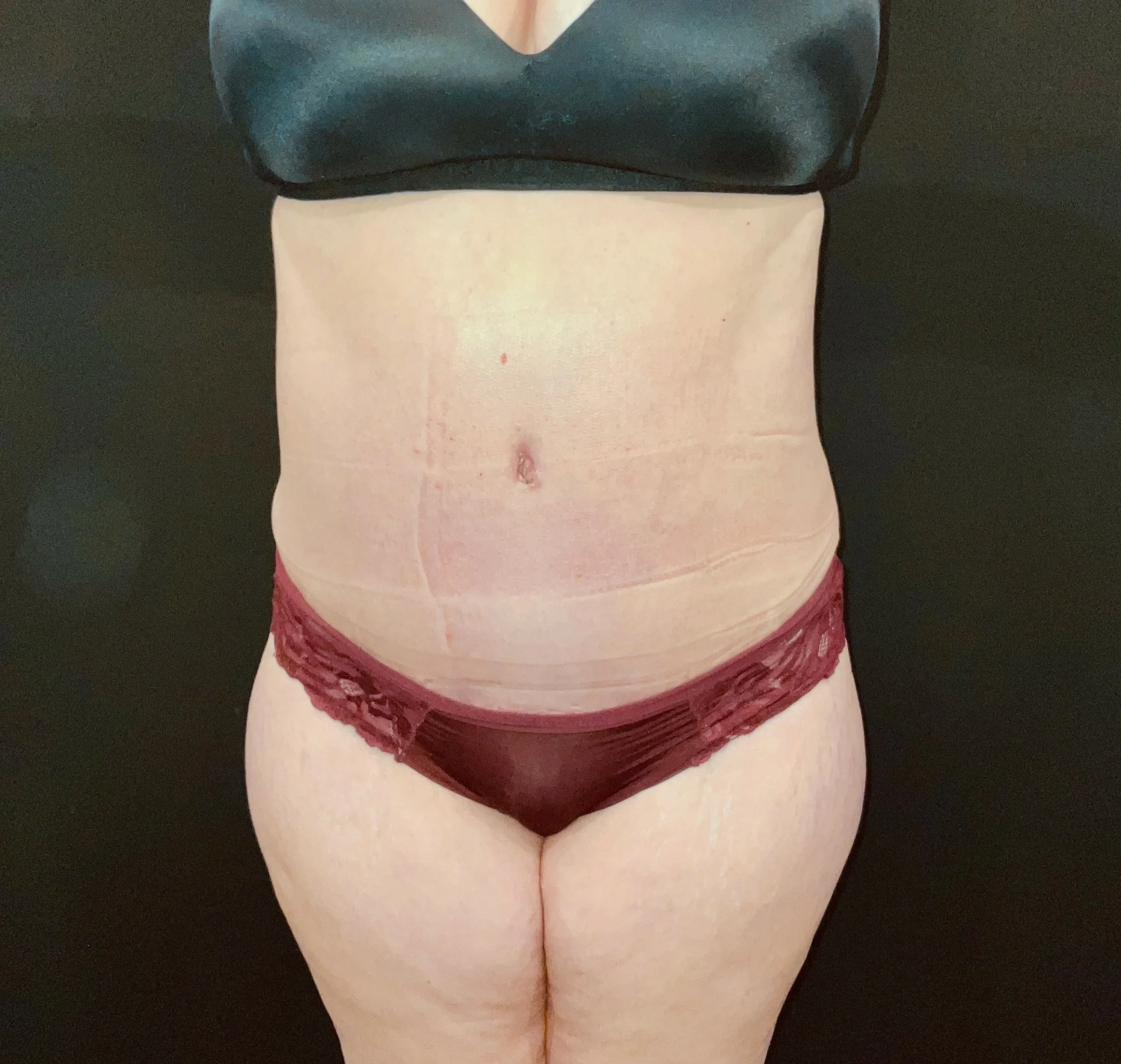 Abdominoplasty (Tummy Tuck) before and after - after