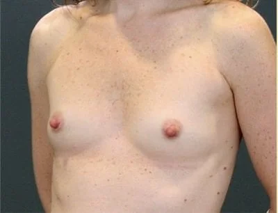 Breast Augmentation before and after - before