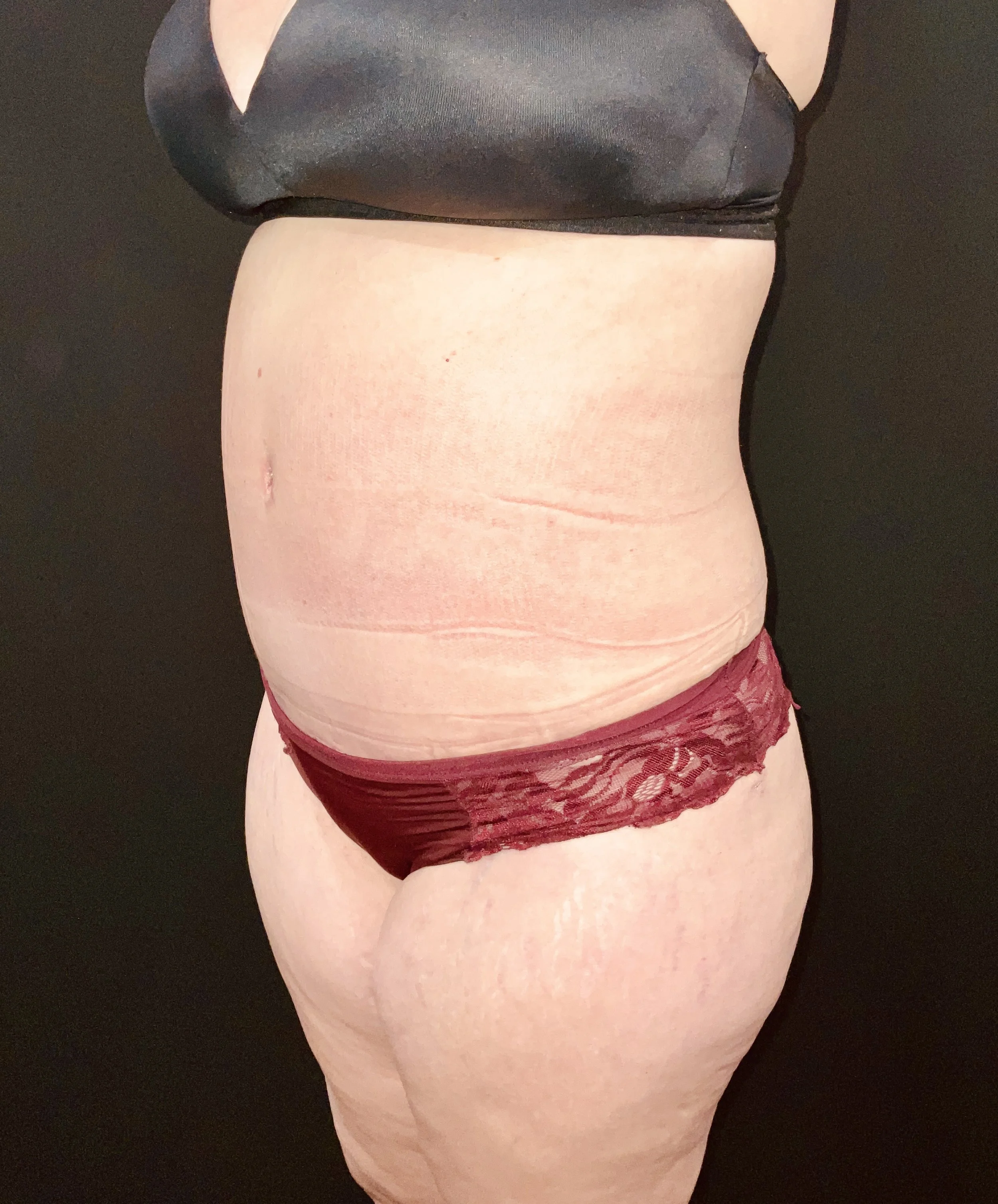 Abdominoplasty (Tummy Tuck) before and after - after