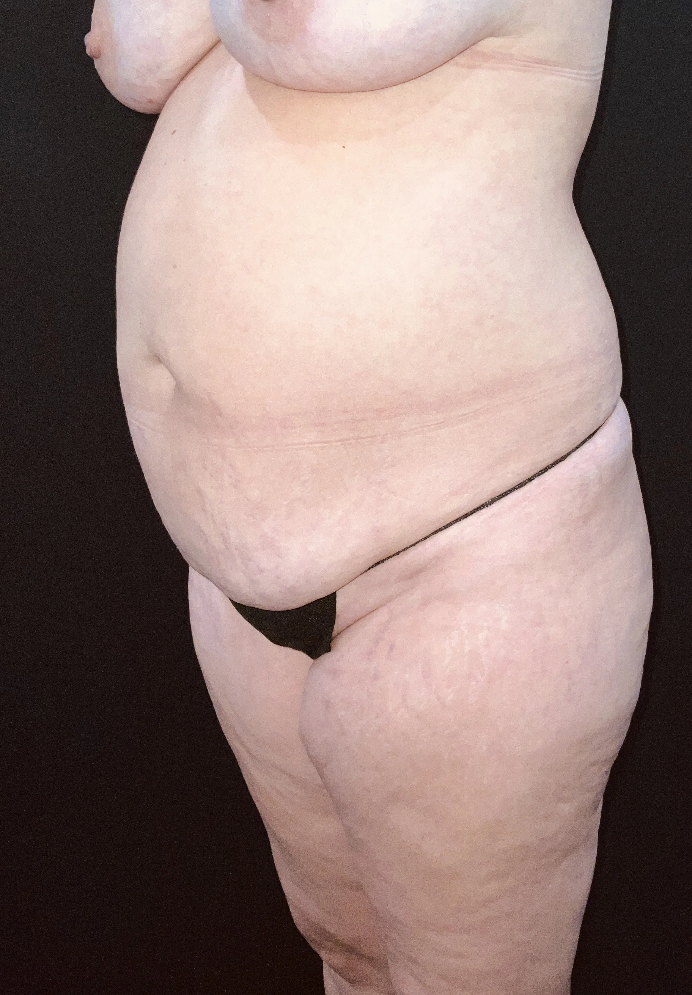 Abdominoplasty (Tummy Tuck) before and after - before