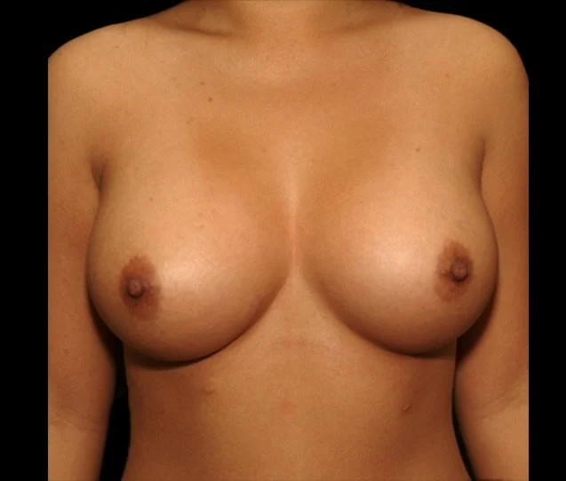 Breast Augmentation before and after - before