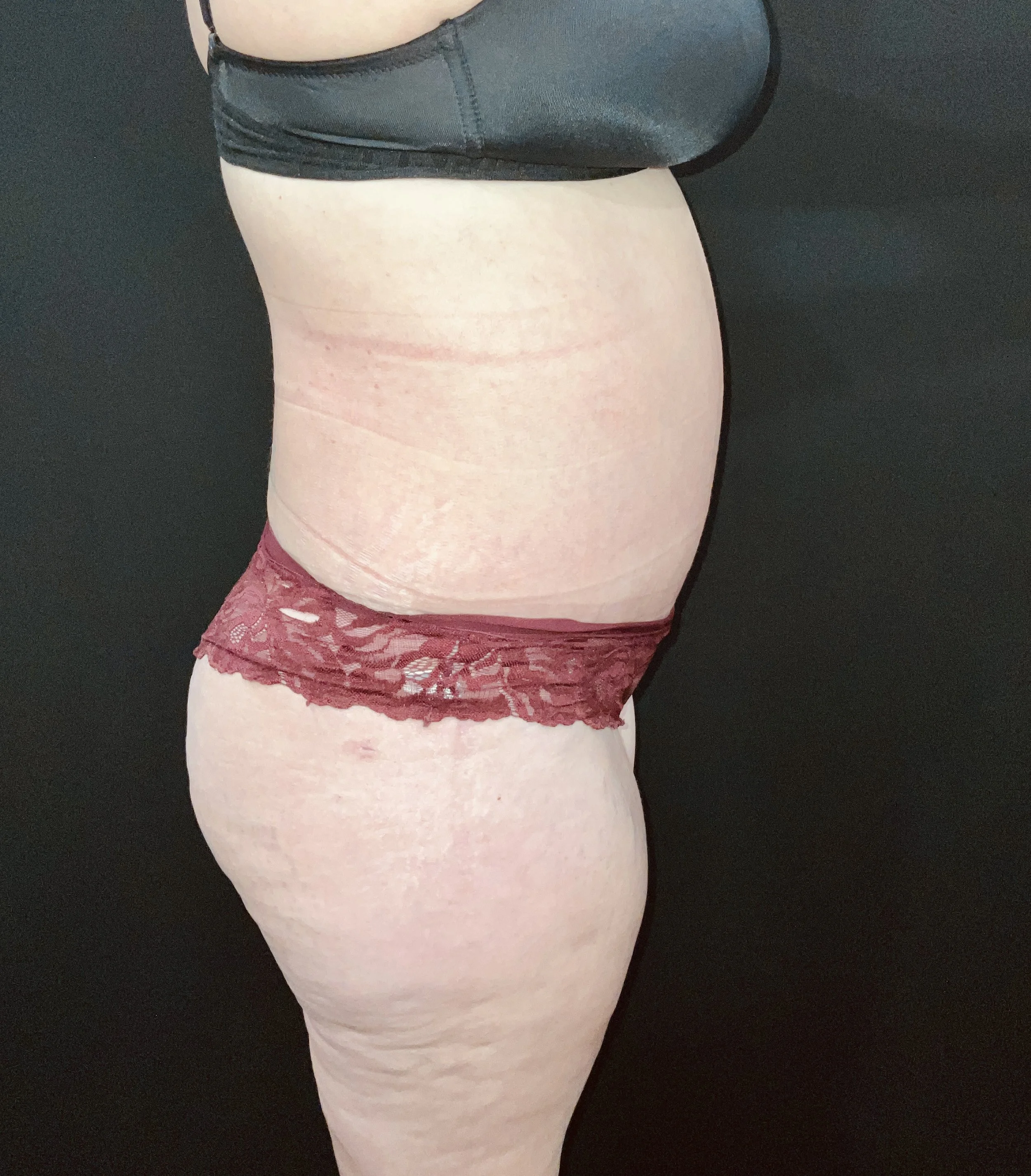 Abdominoplasty (Tummy Tuck) before and after - after