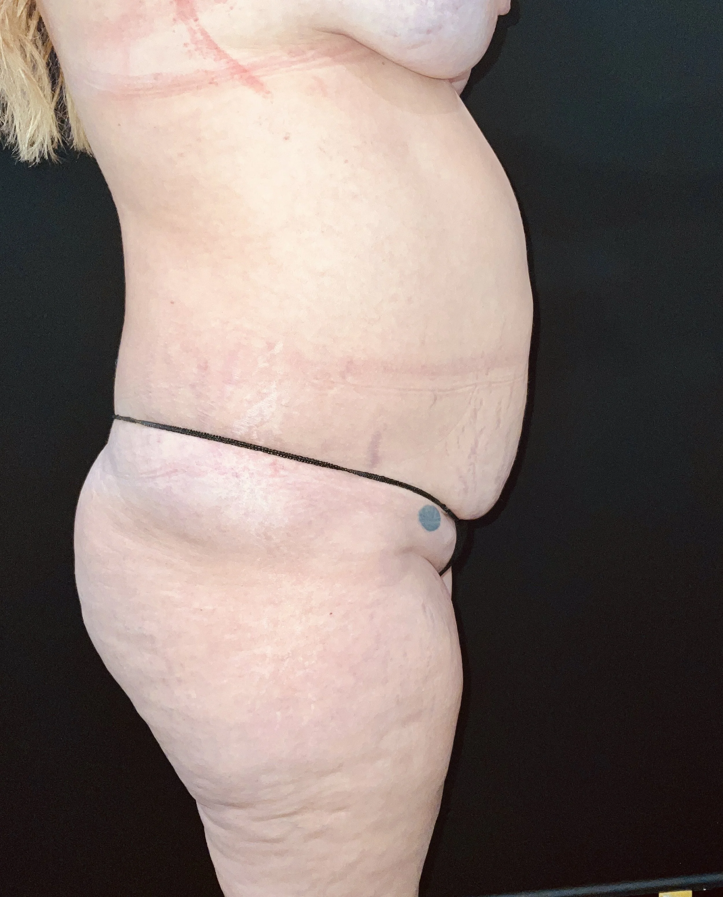 Abdominoplasty (Tummy Tuck) before and after - before
