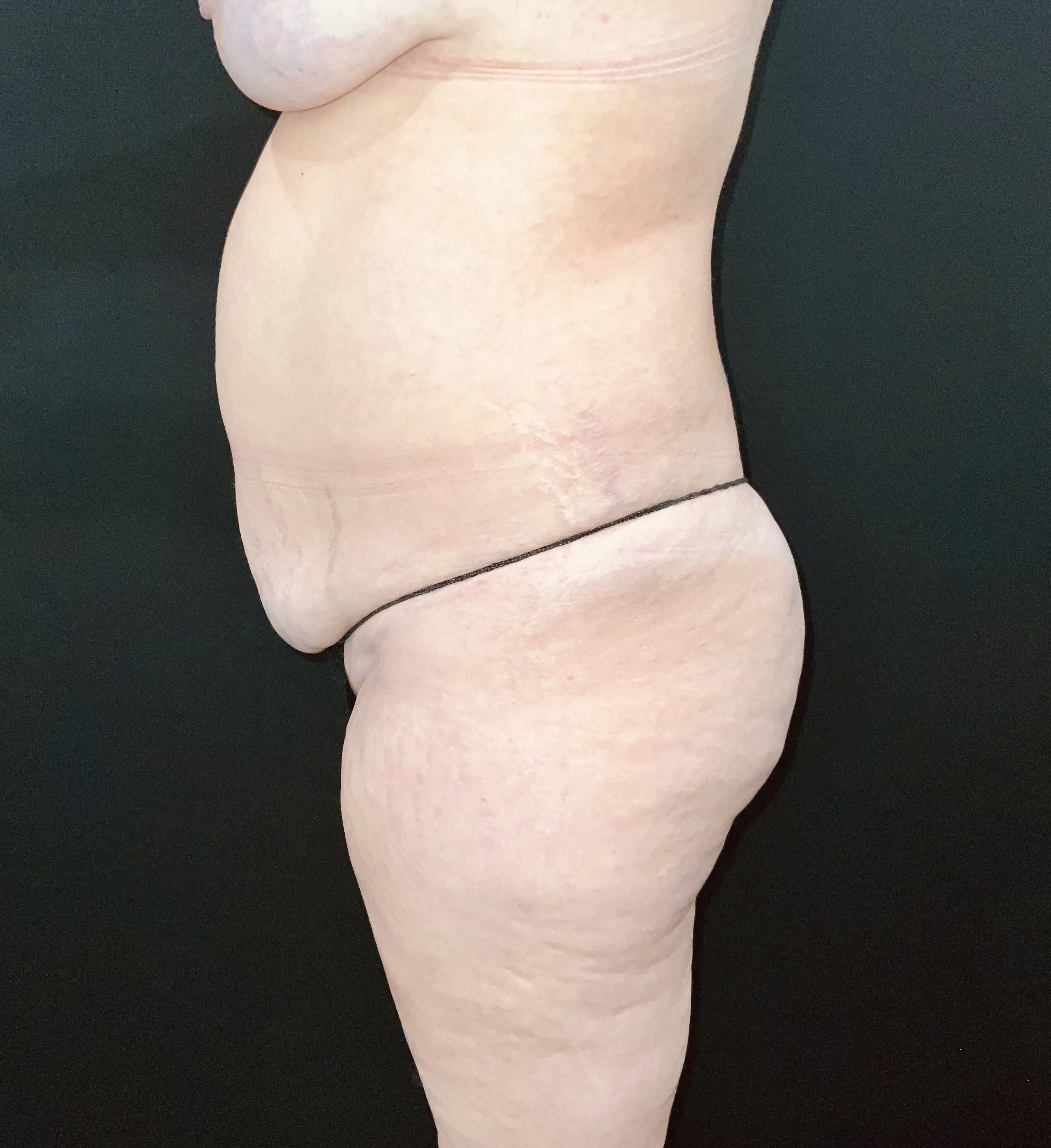Abdominoplasty (Tummy Tuck) before and after - before