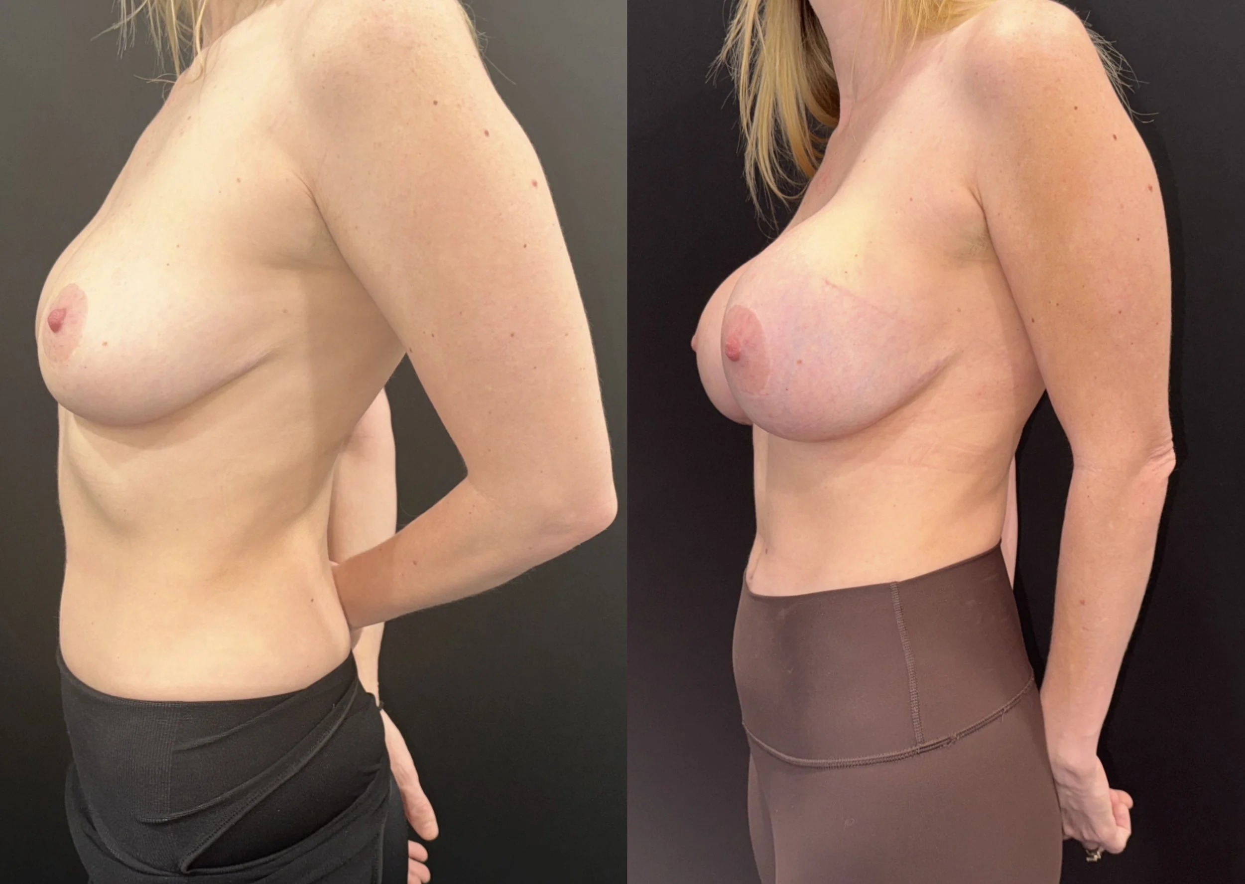 Breast Augmentation before and after - after