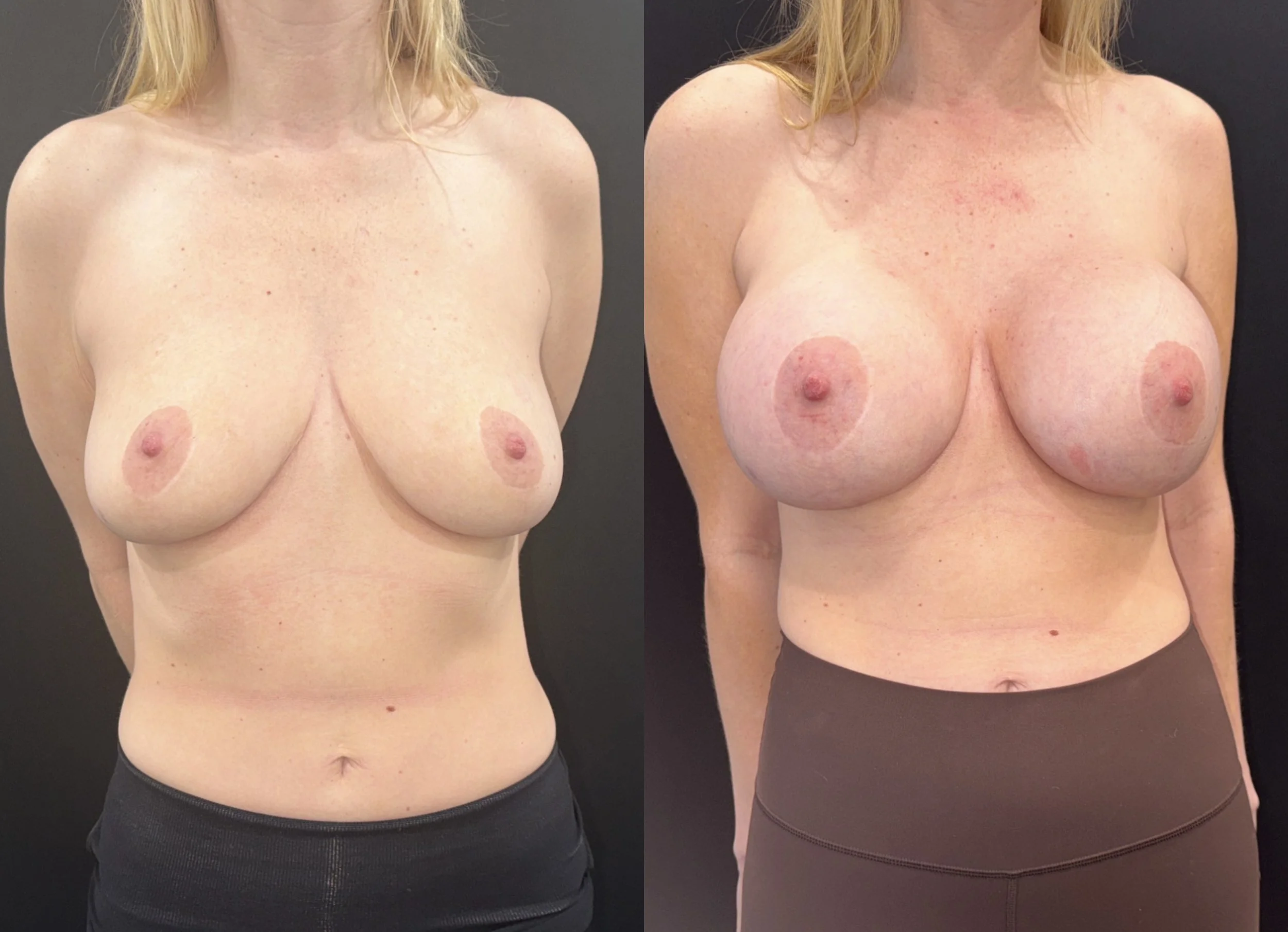 Breast Augmentation before and after - before