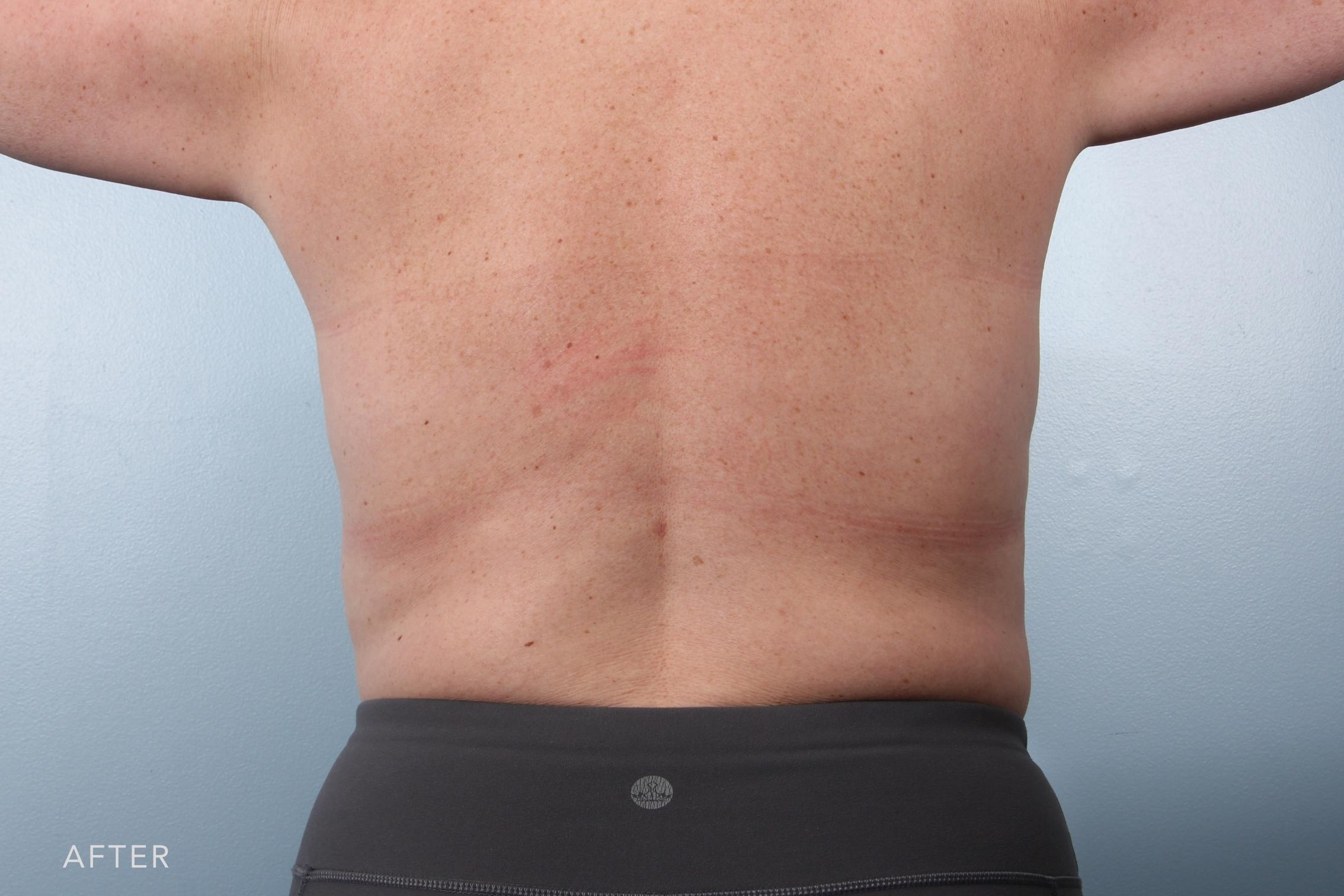 Liposuction before and after - after
