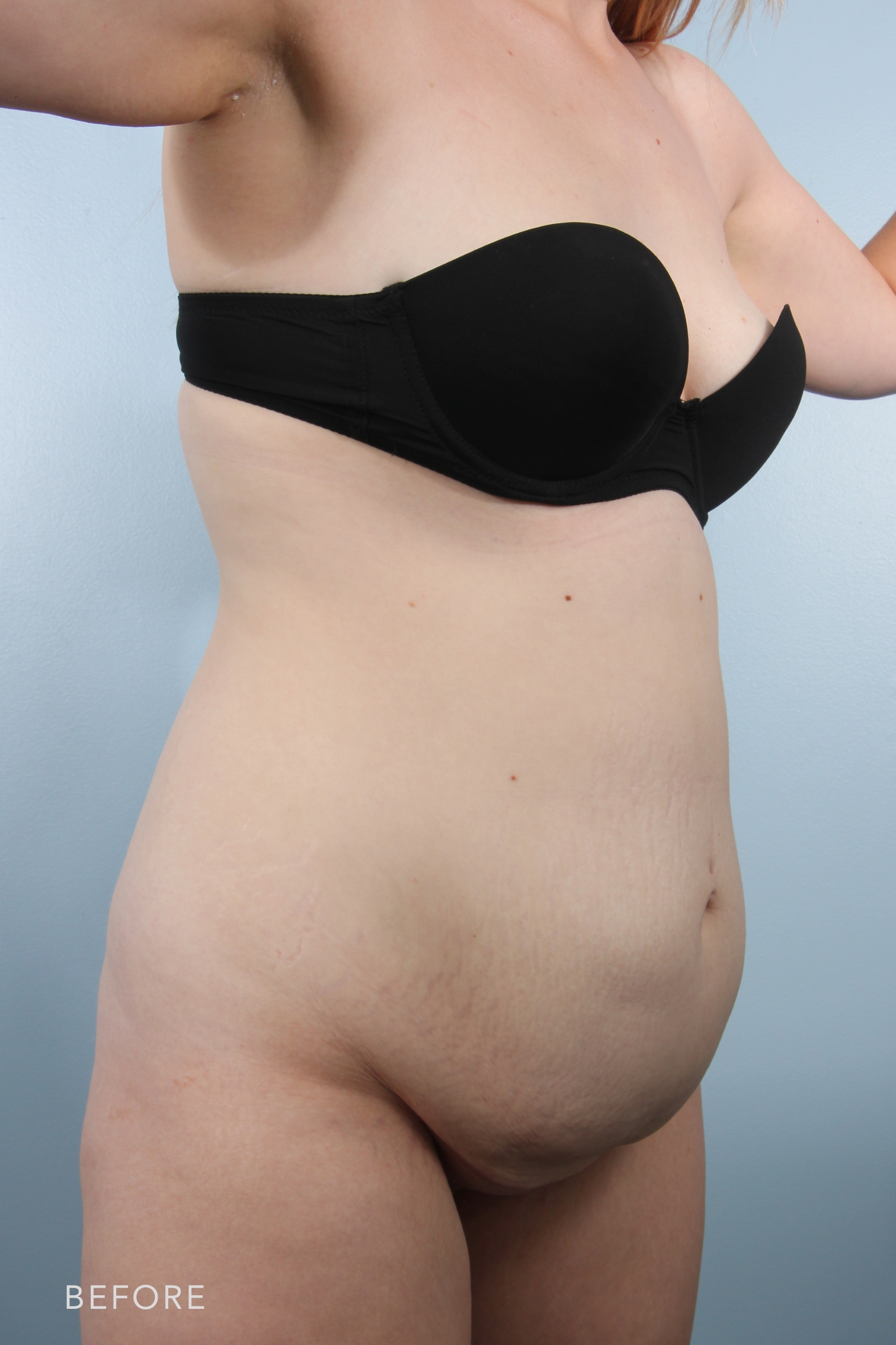 Tummy Tuck before — Dr. Alfredo Lloreda