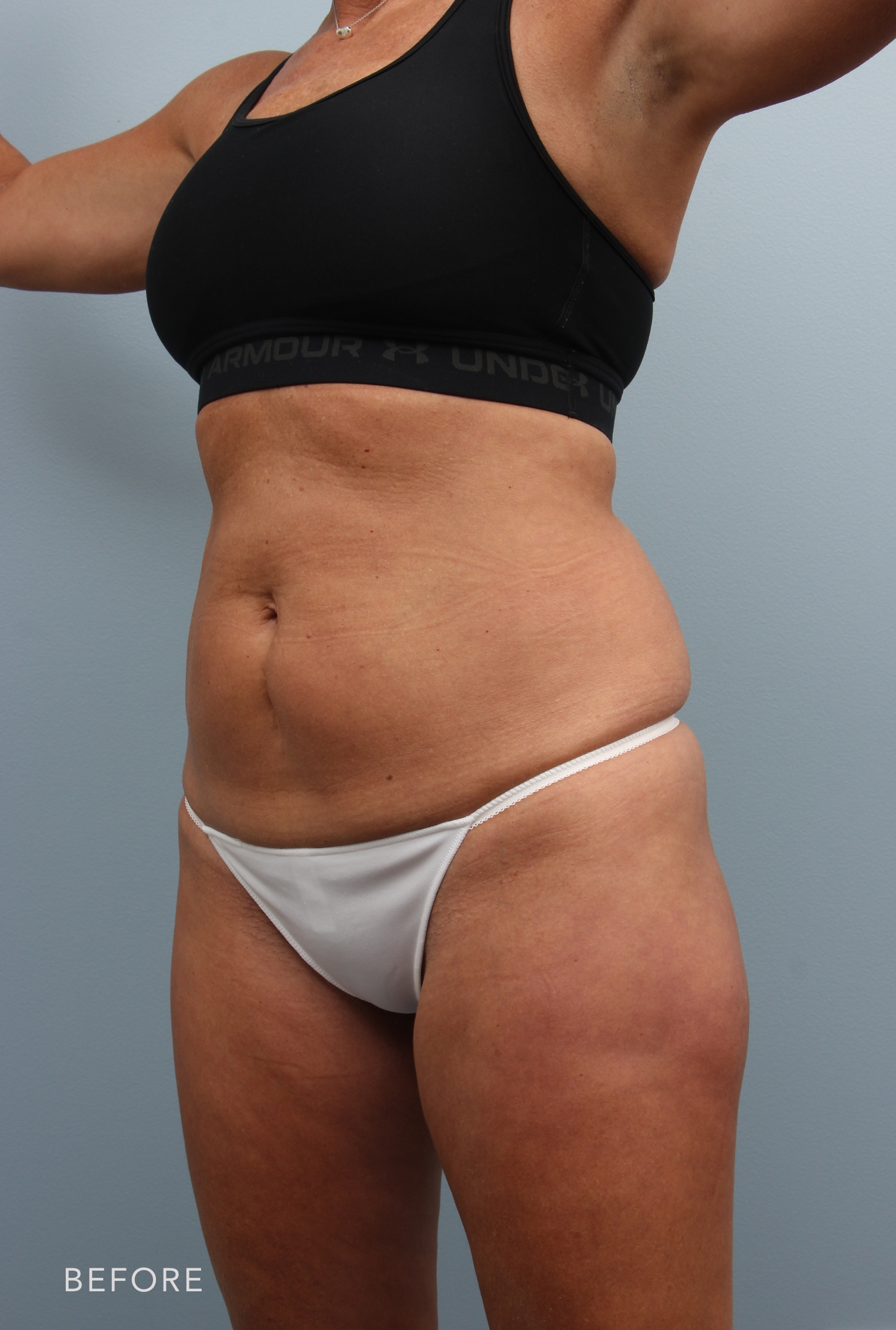 Tummy Tuck before and after - before