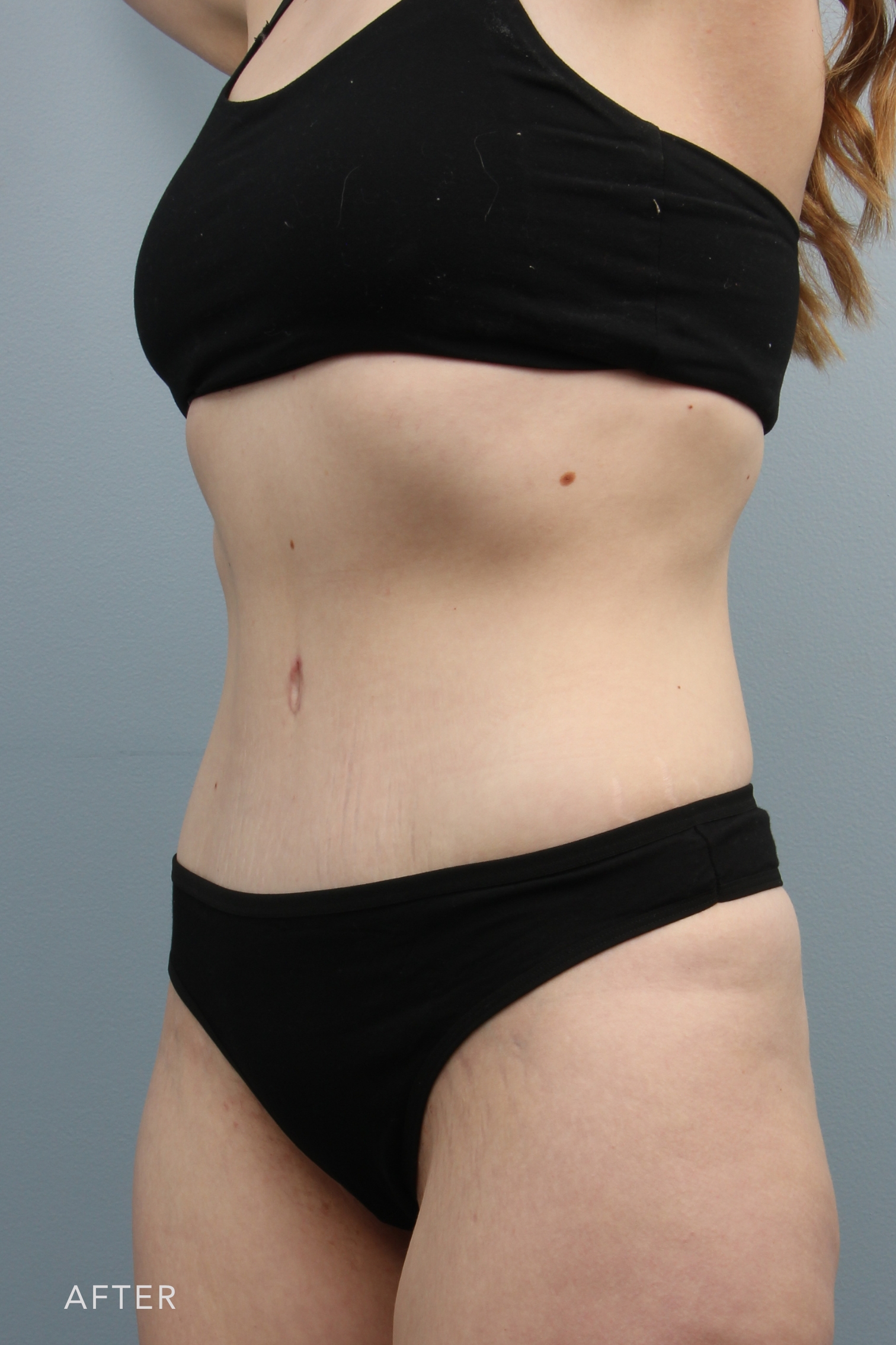 Tummy Tuck after — Dr. Alfredo Lloreda