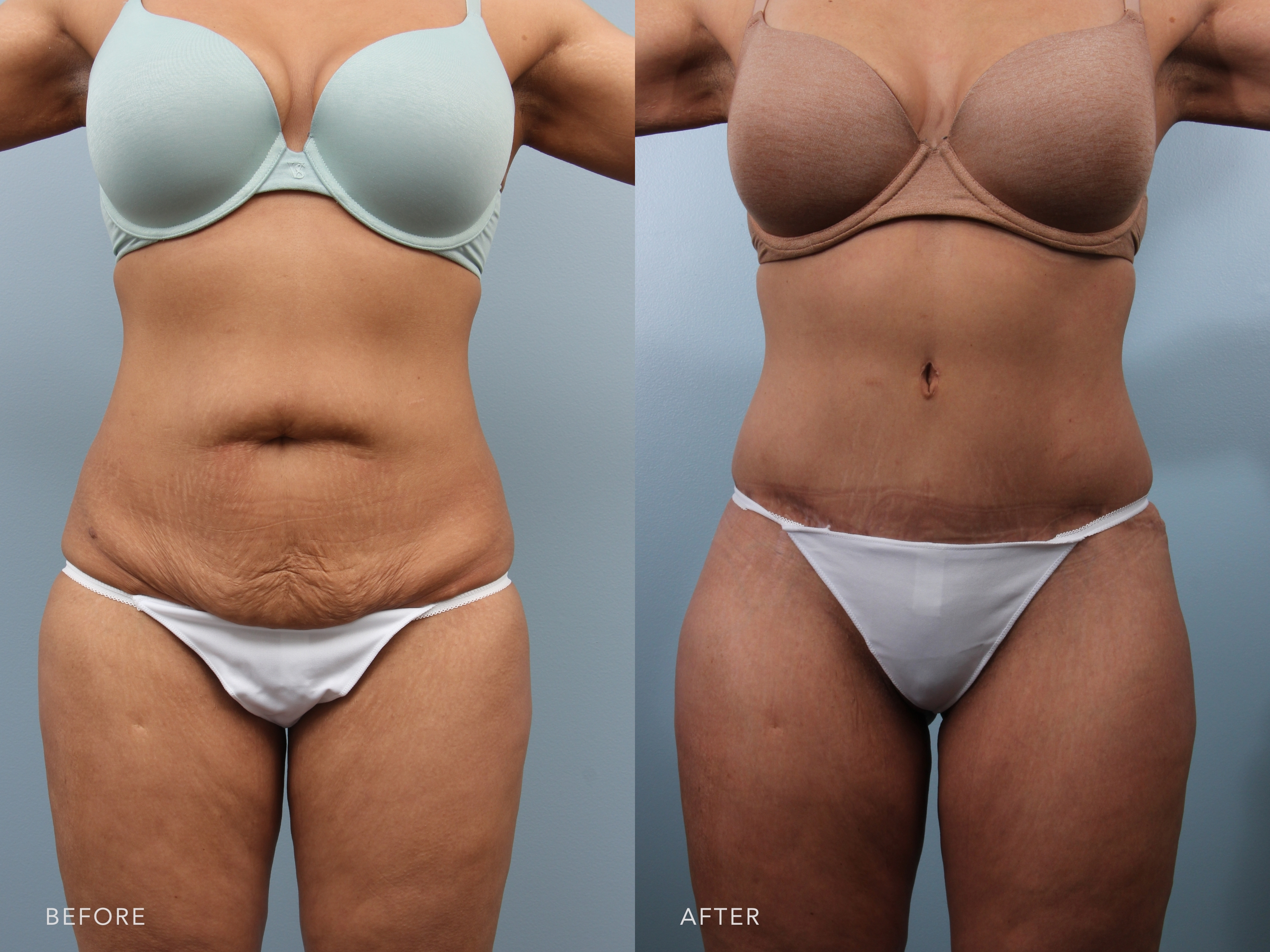 Tummy Tuck before and after - after