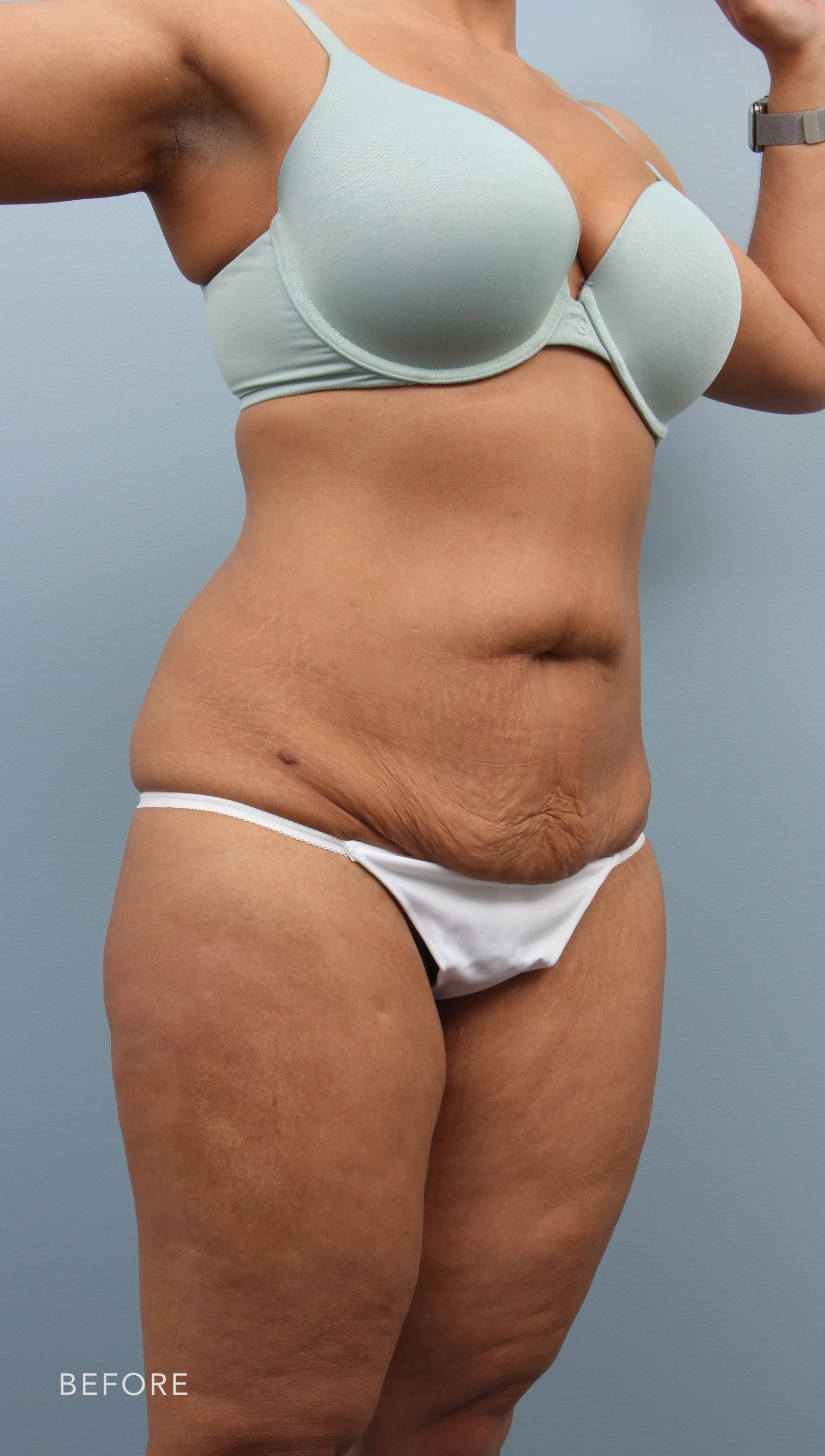 Tummy Tuck before and after - before