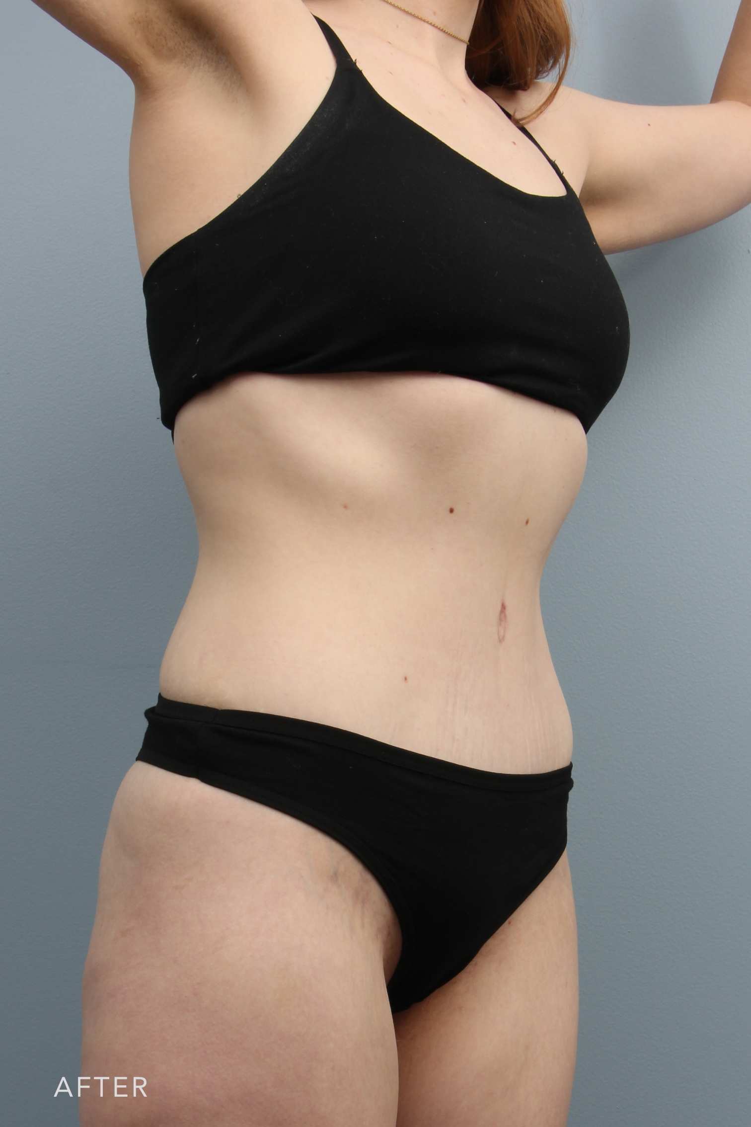 Tummy Tuck after — Dr. Alfredo Lloreda