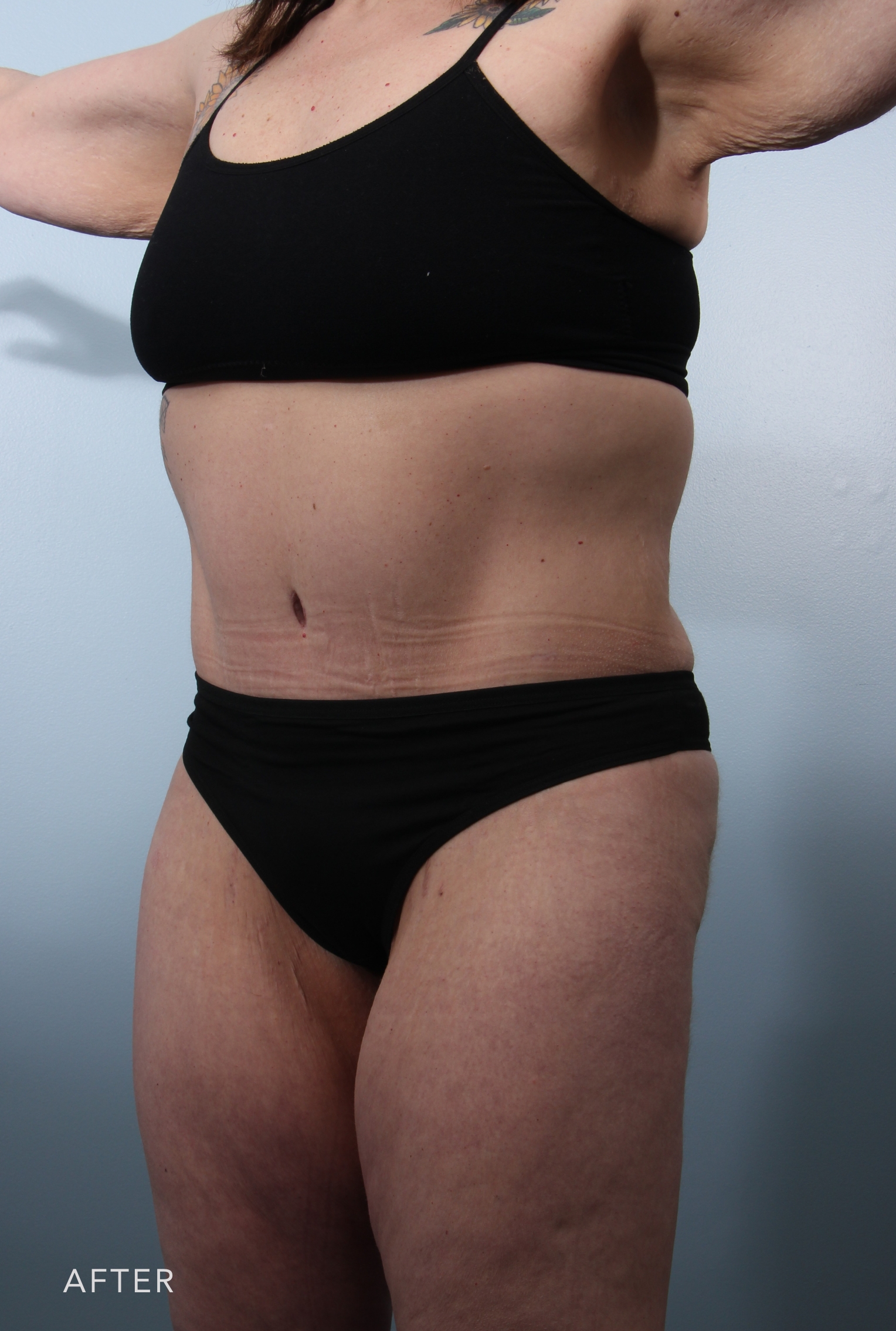 Procedure before and after - after