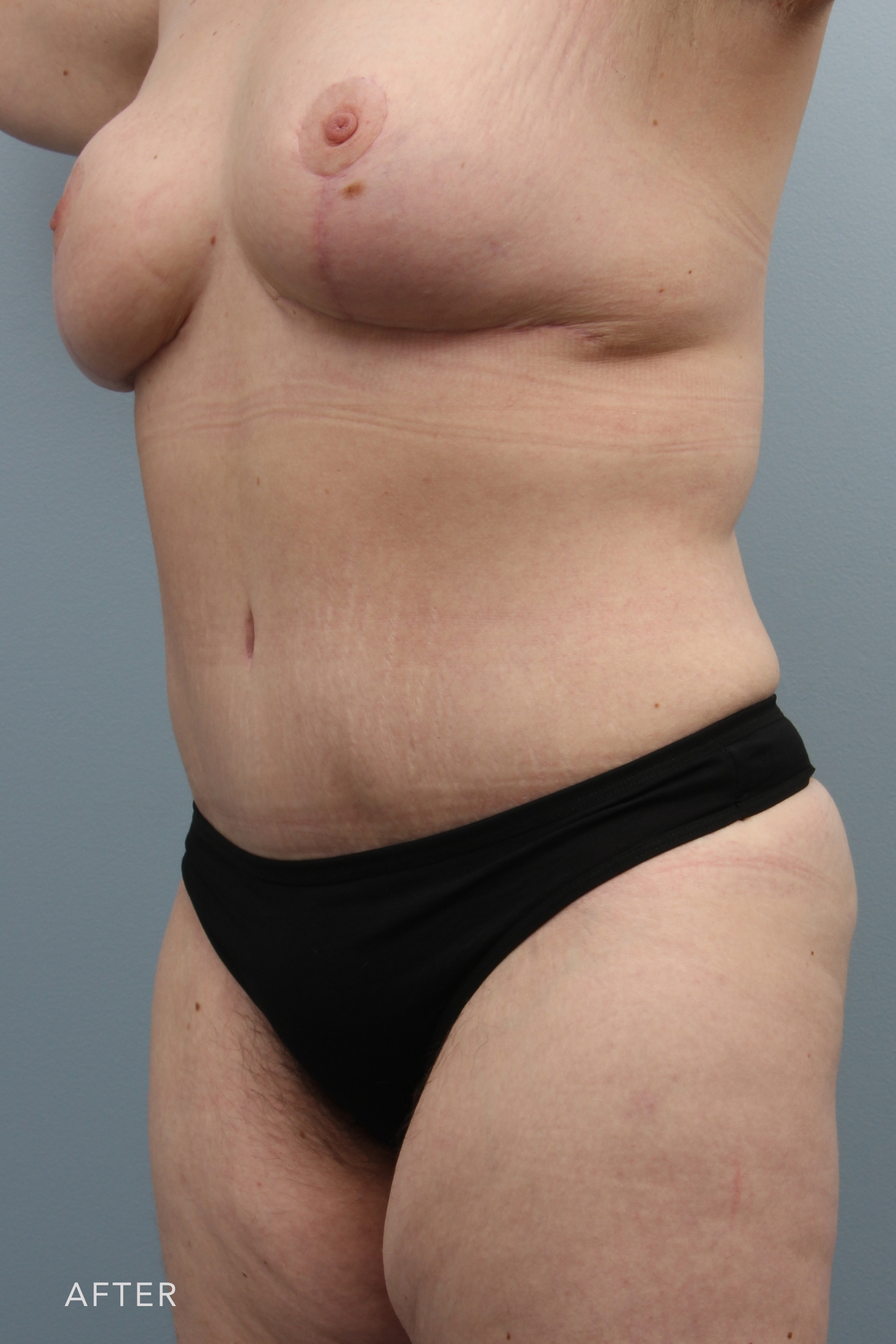 Mommy Makeover before and after - after