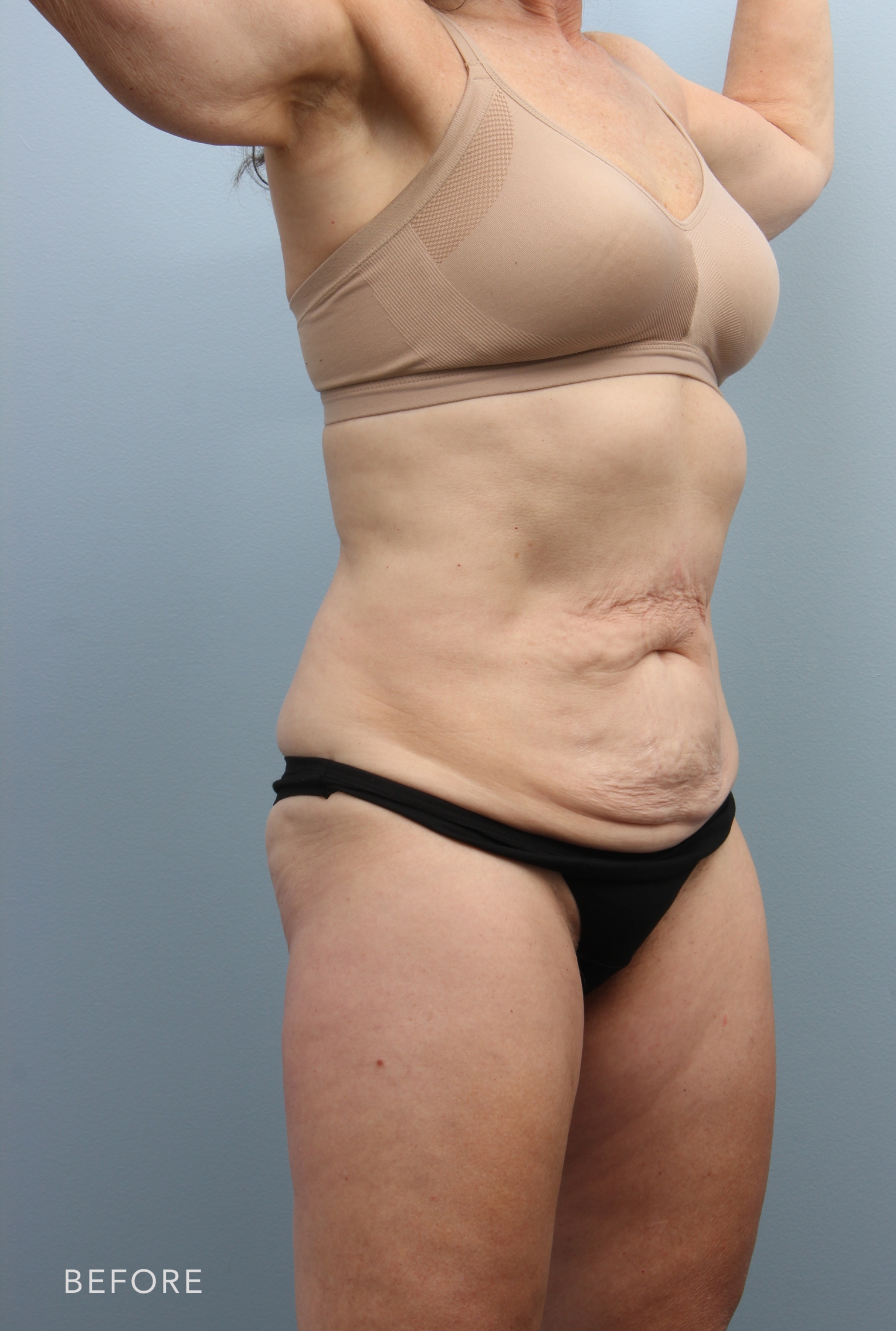Liposuction before and after - before
