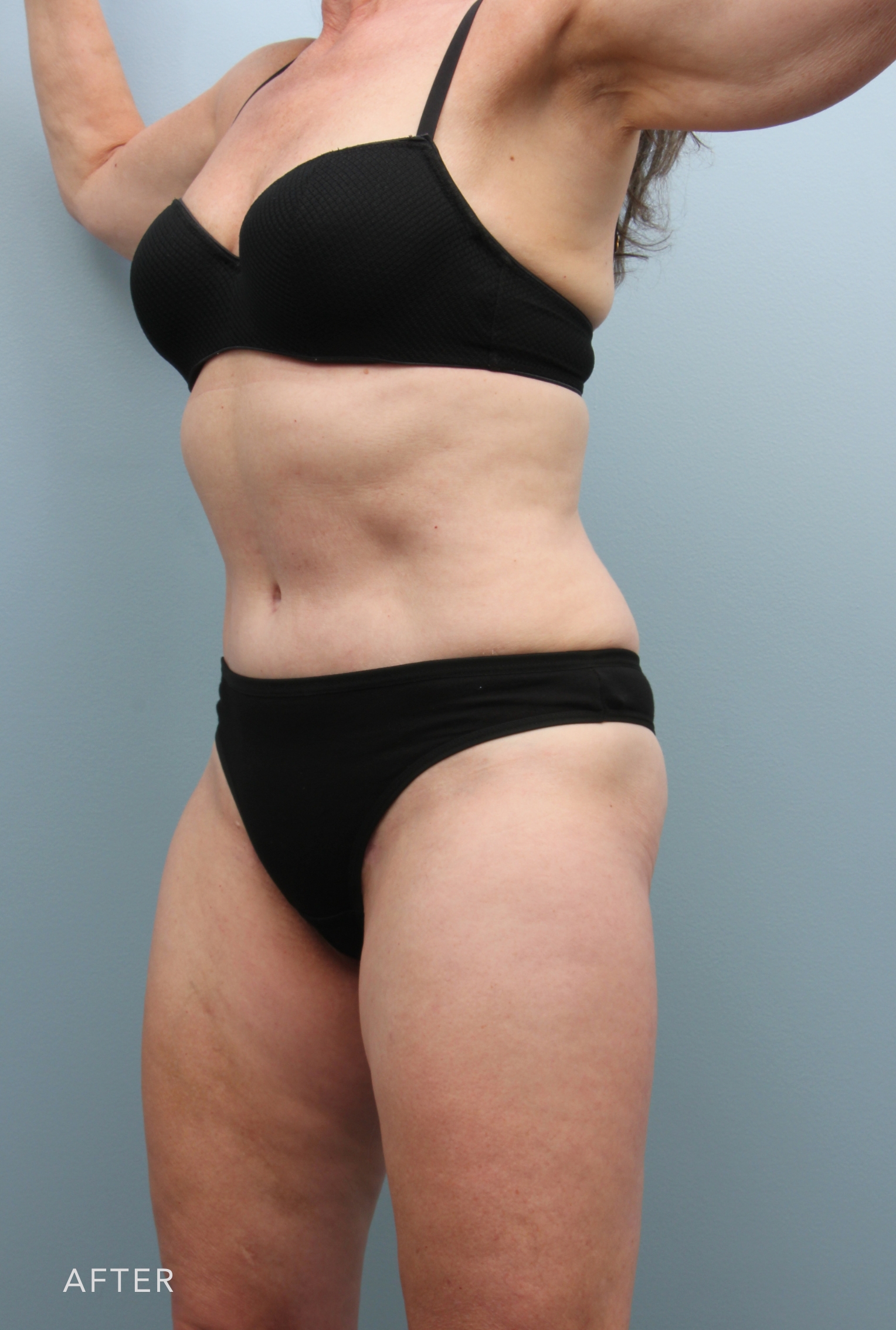 Liposuction before and after - after