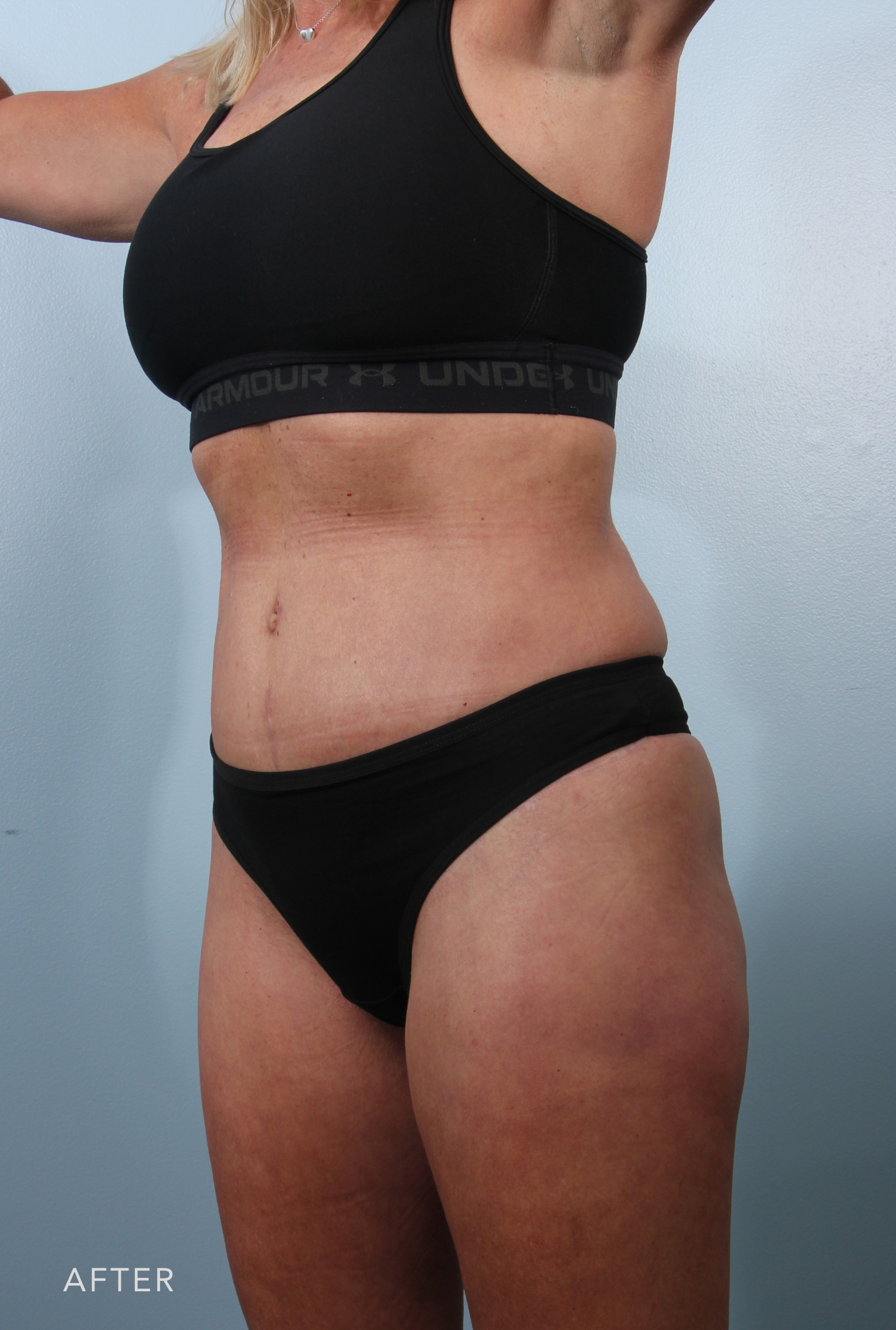 Tummy Tuck before and after - after