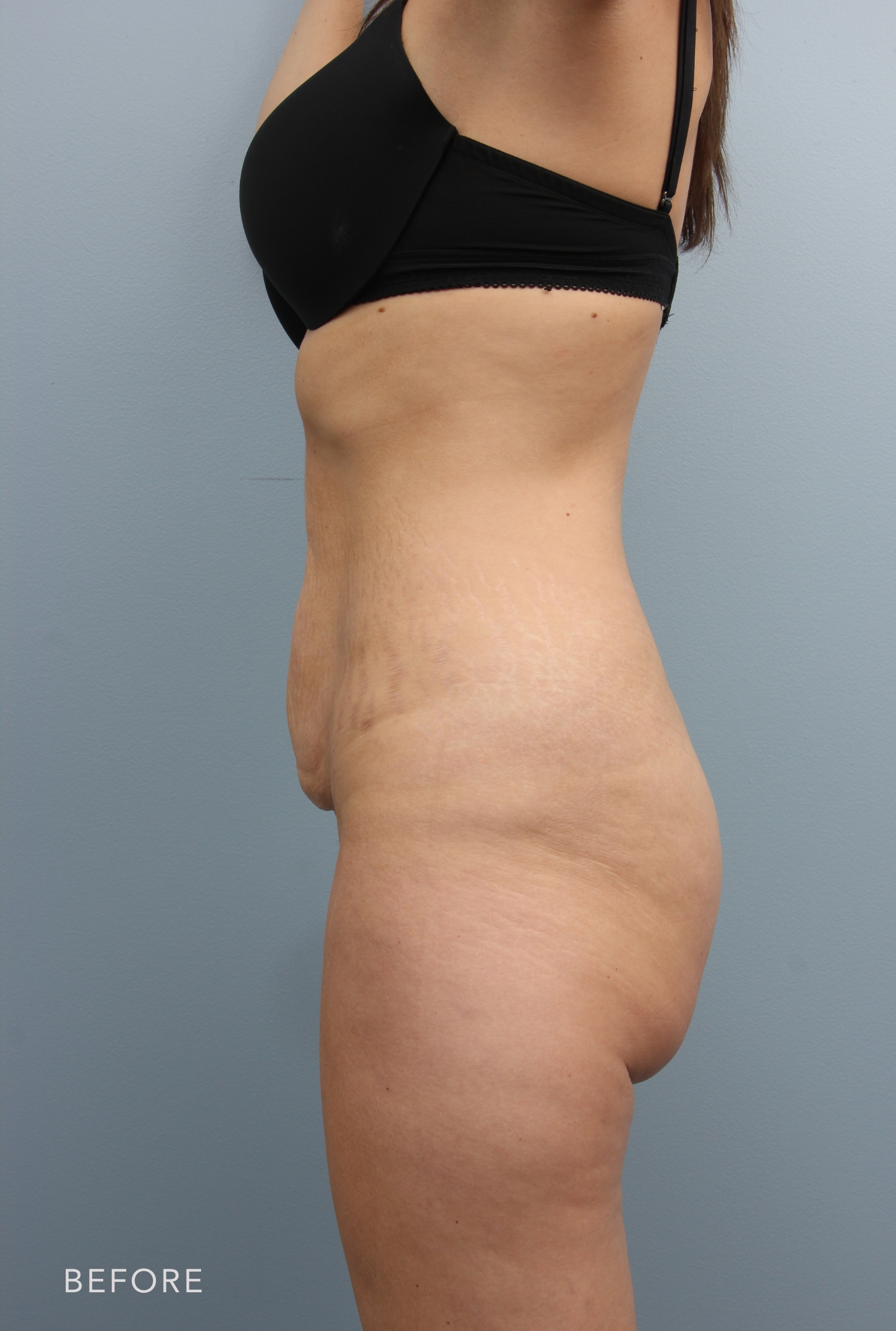 Body Lift before — Dr. Alfredo Lloreda