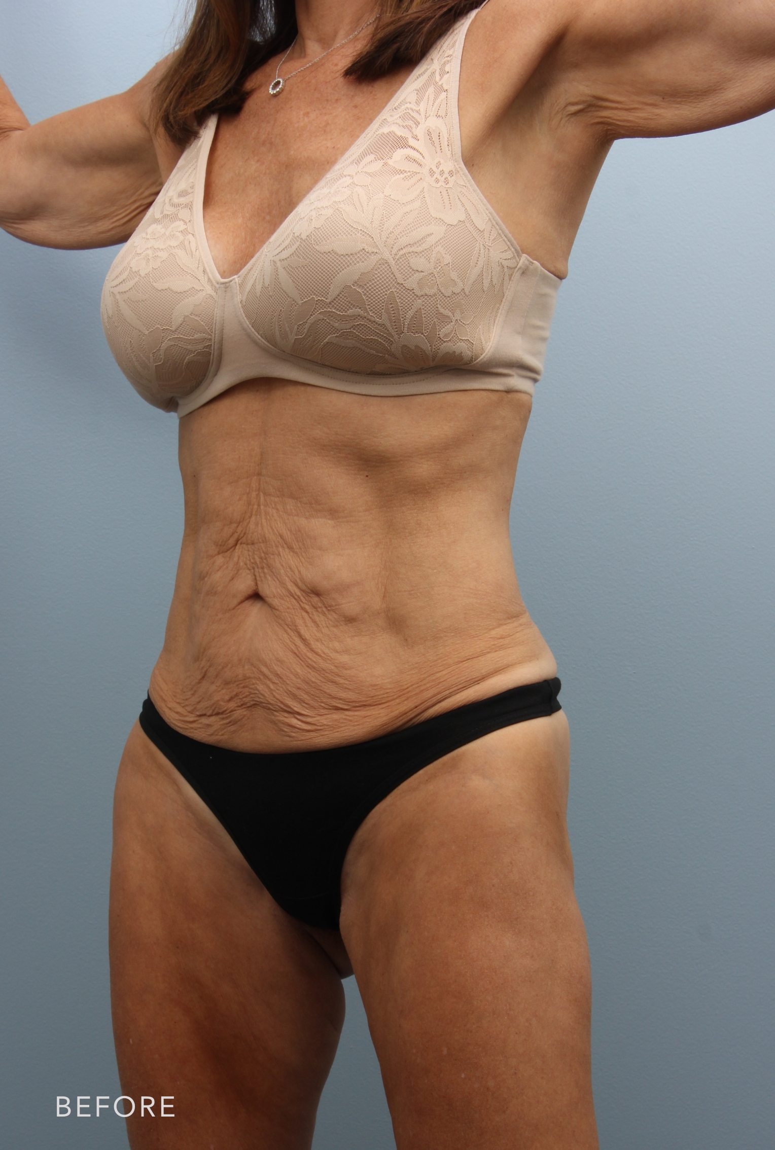 Tummy Tuck before — Dr. Alfredo Lloreda