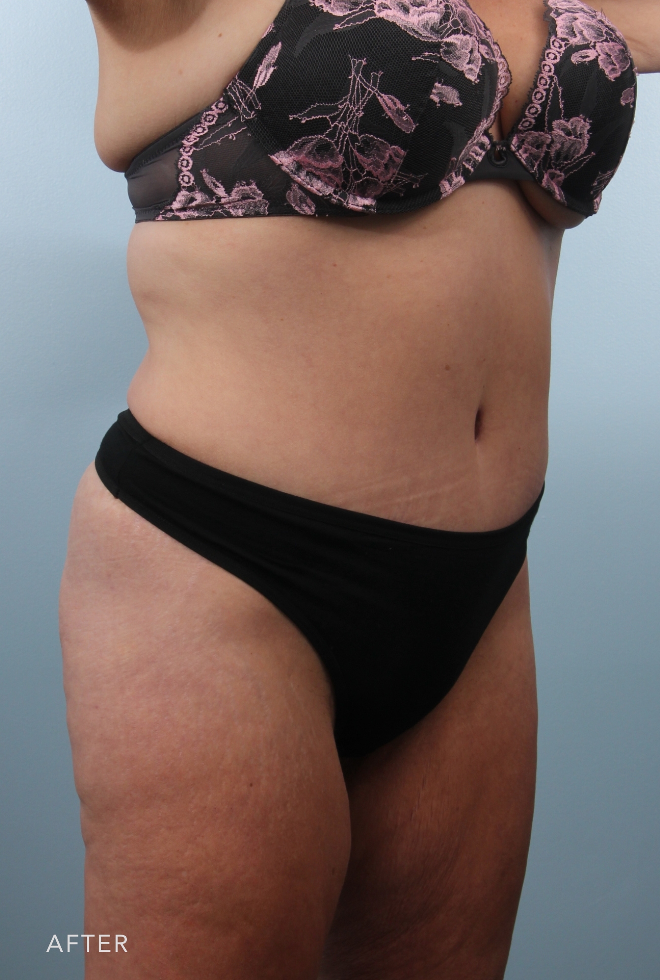 Procedure before and after - after