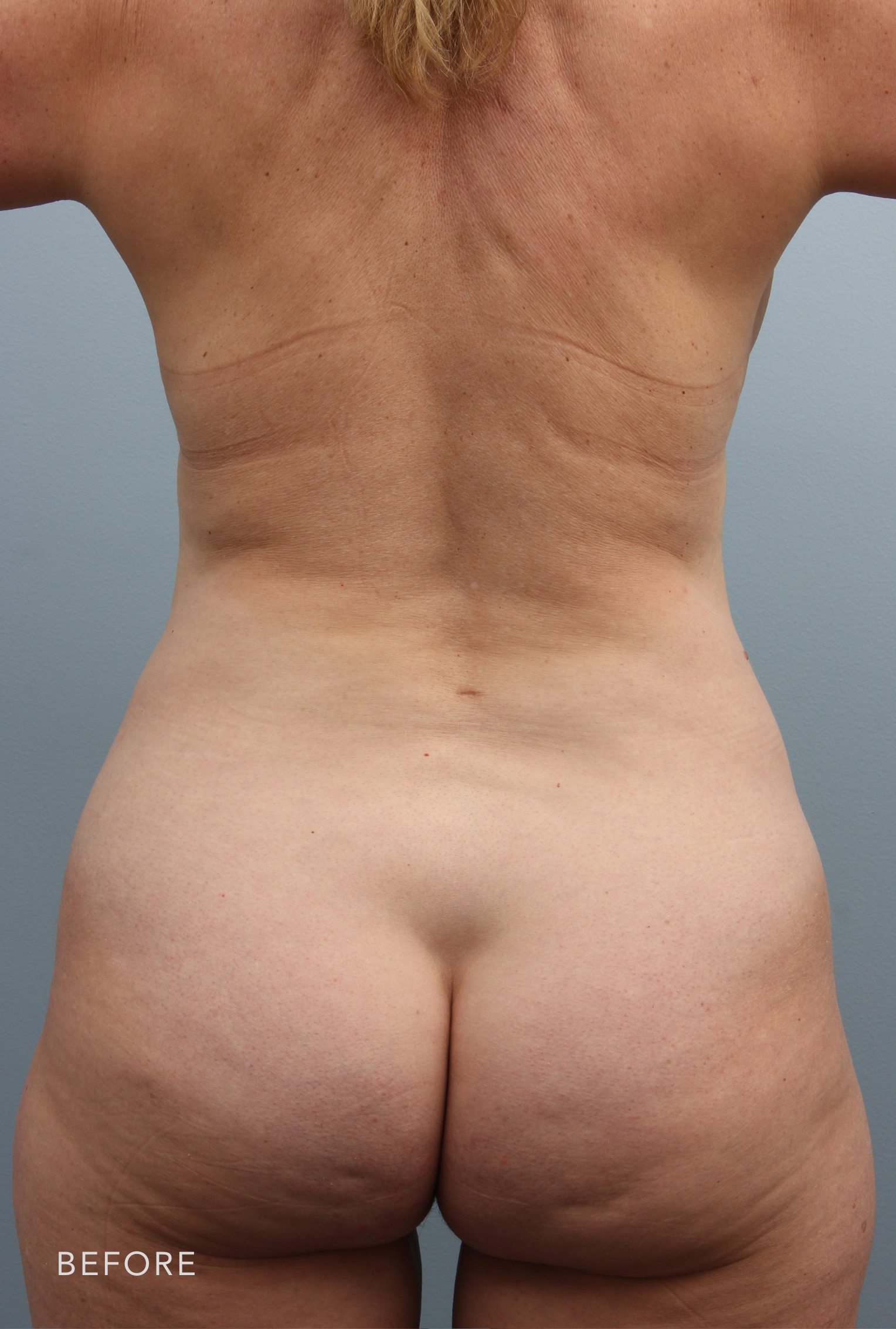 Tummy Tuck before — Dr. Alfredo Lloreda