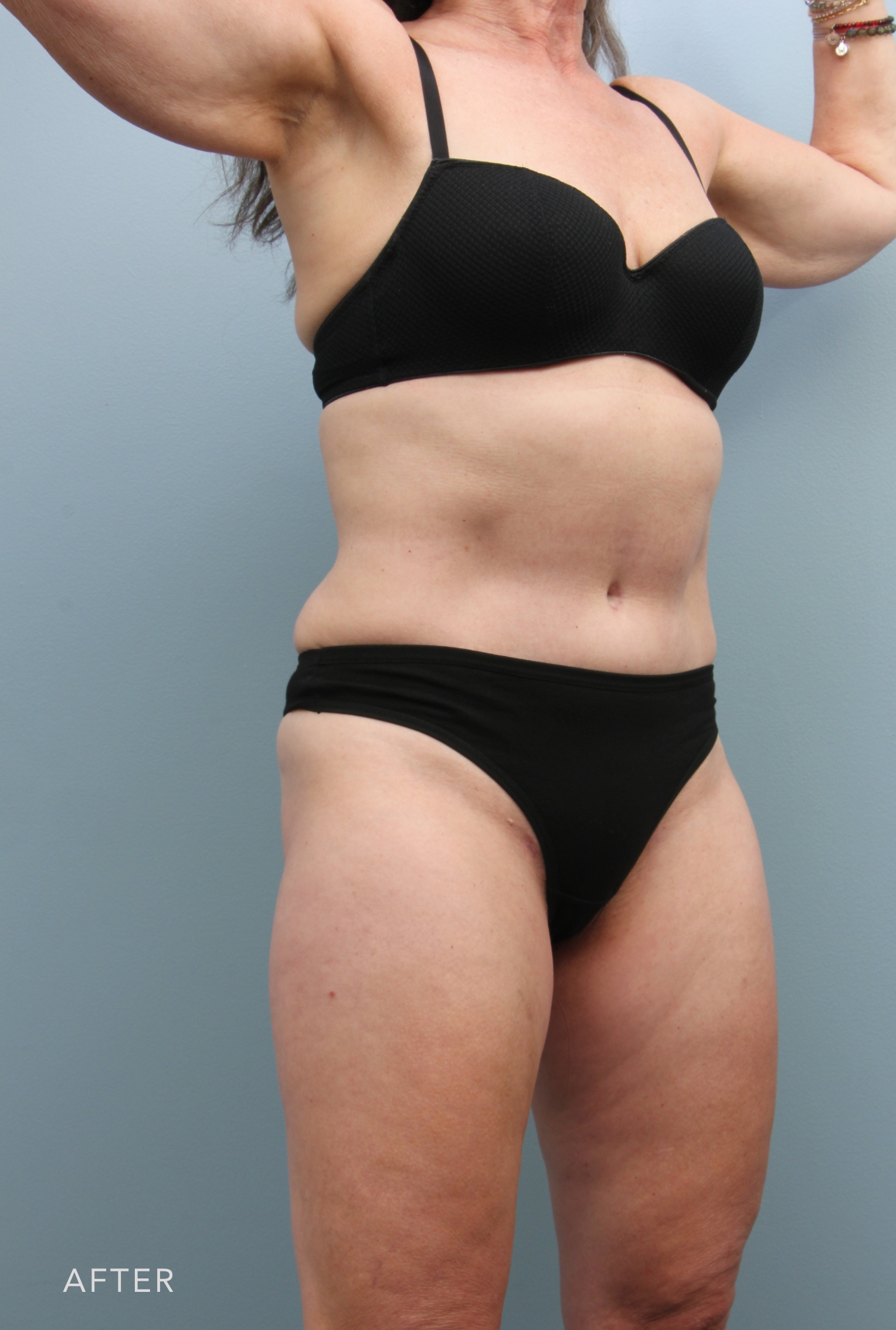 Liposuction before and after - after