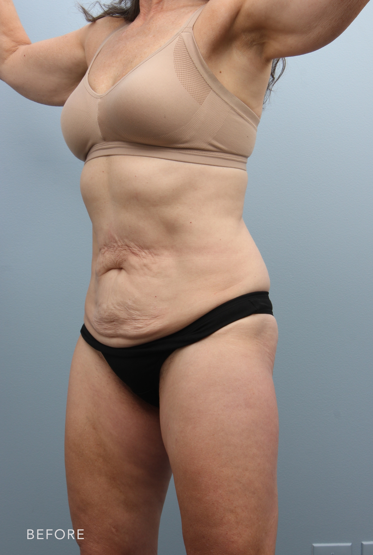 Liposuction before and after - before