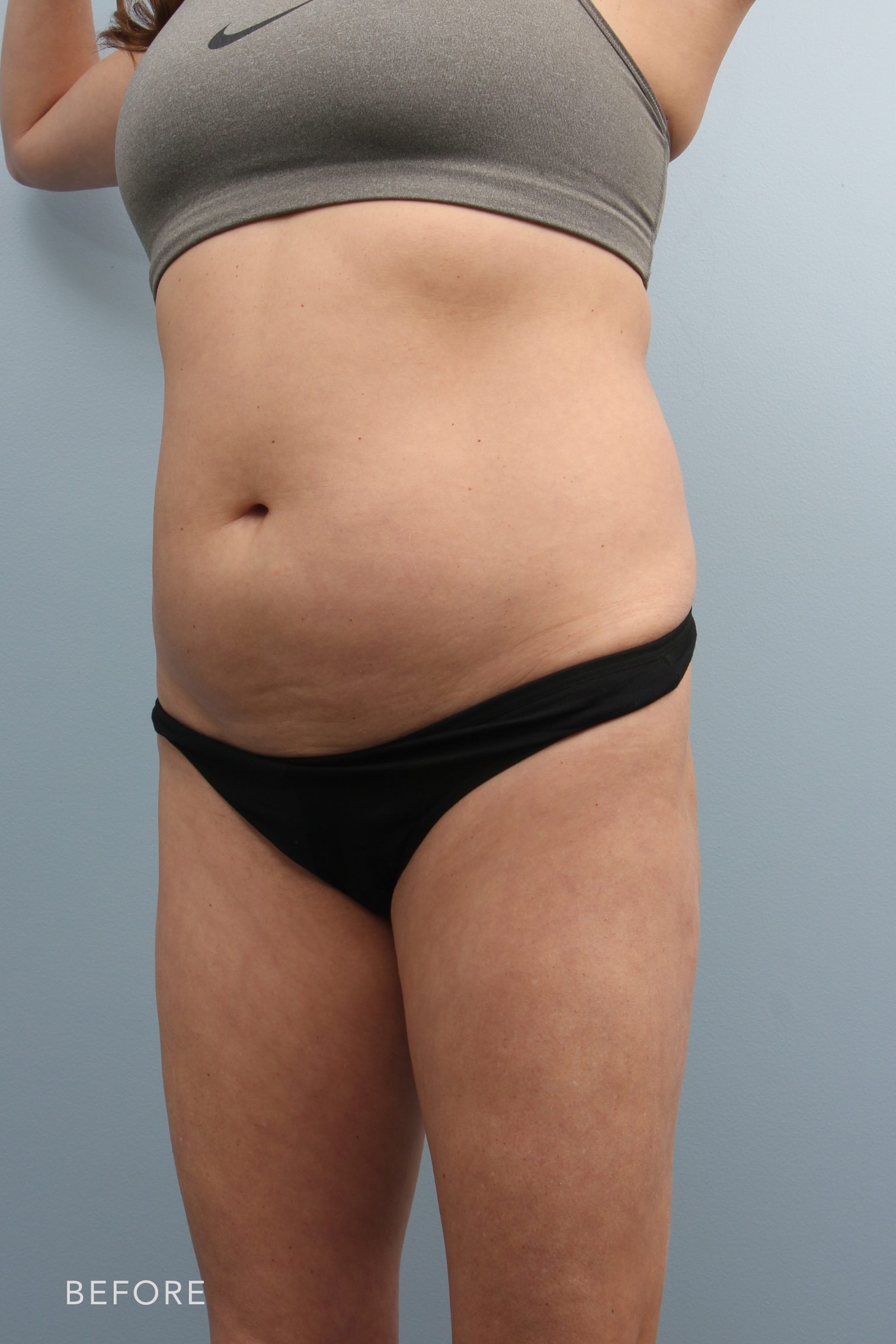 Liposuction before and after - before