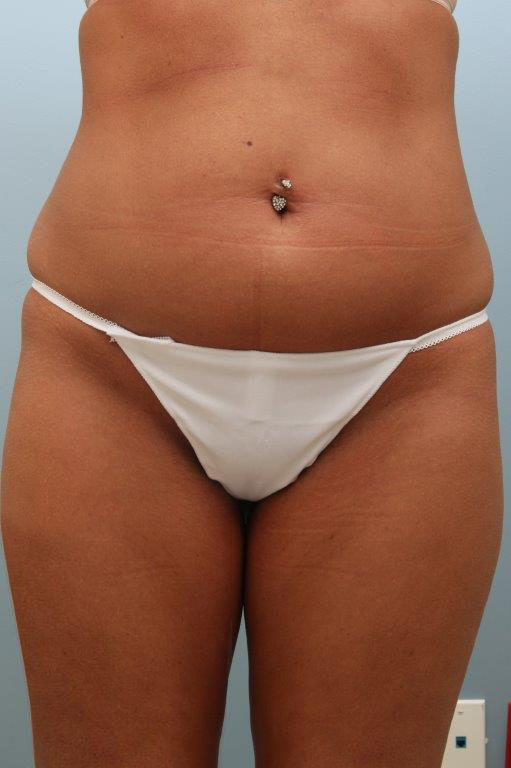 Liposuction before and after - before