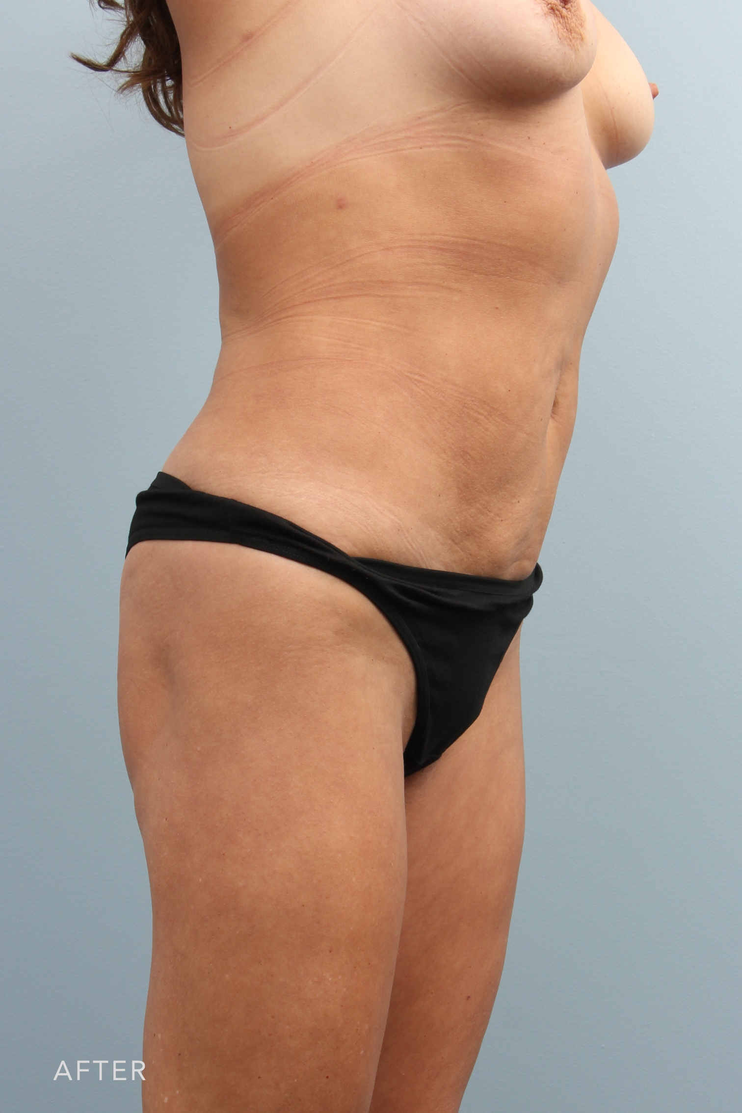 Liposuction before and after - after