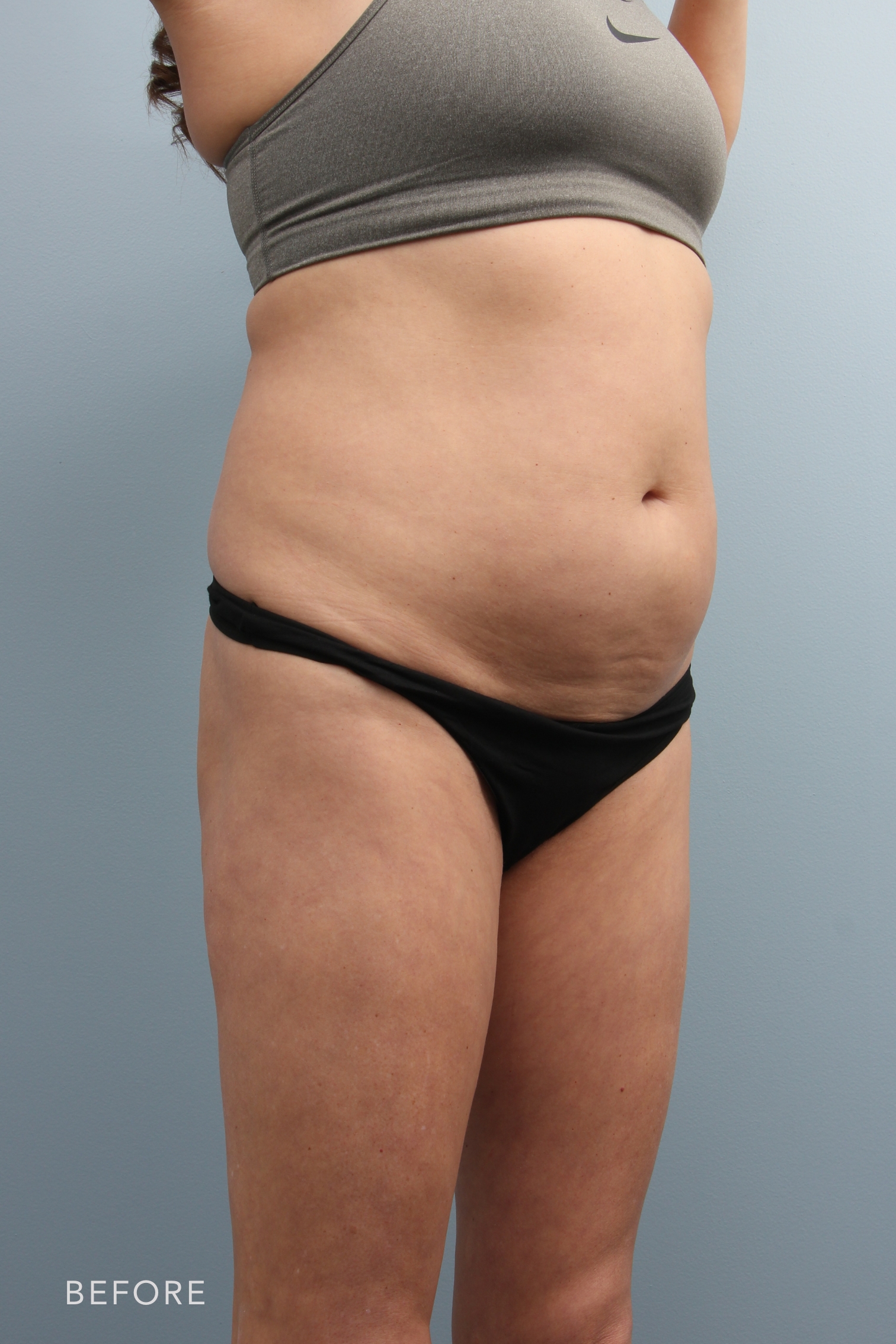 Liposuction before and after - before
