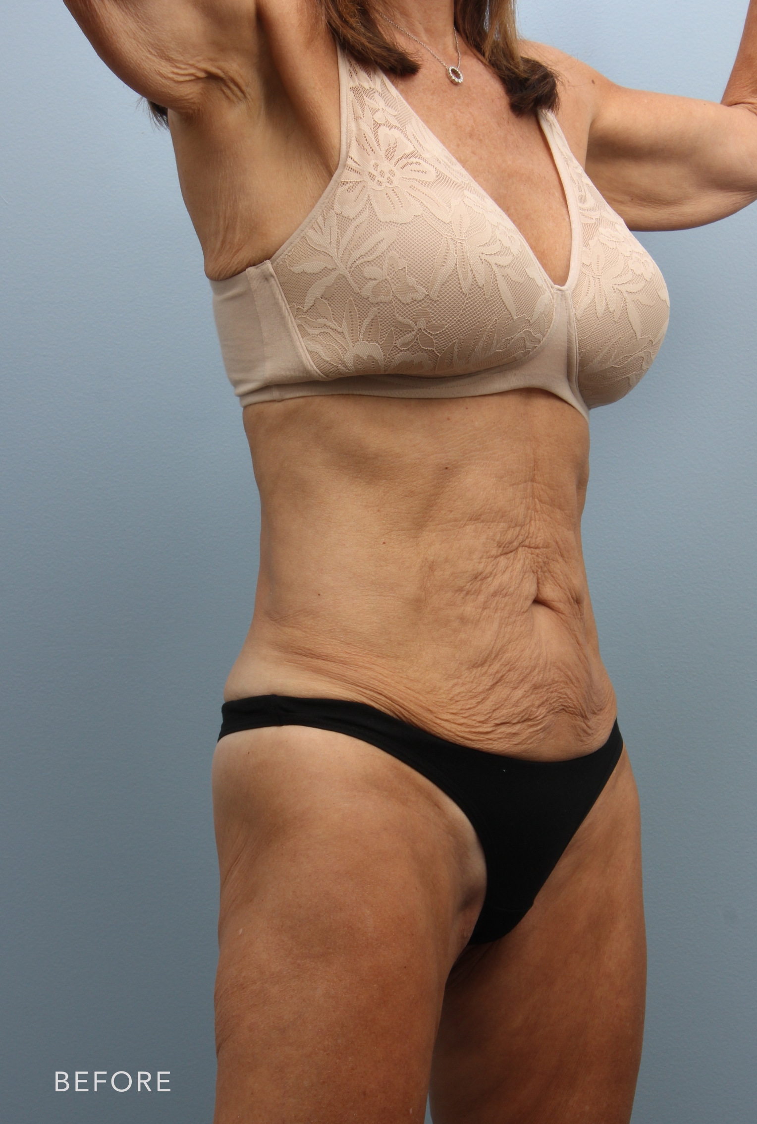 Tummy Tuck before and after - before