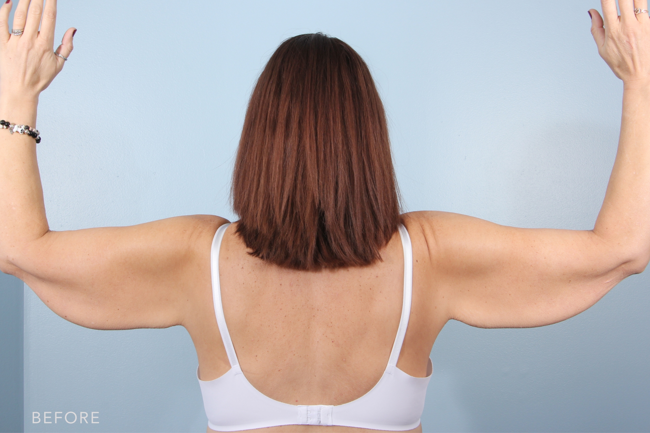 Arm Lift before — Dr. Alfredo Lloreda