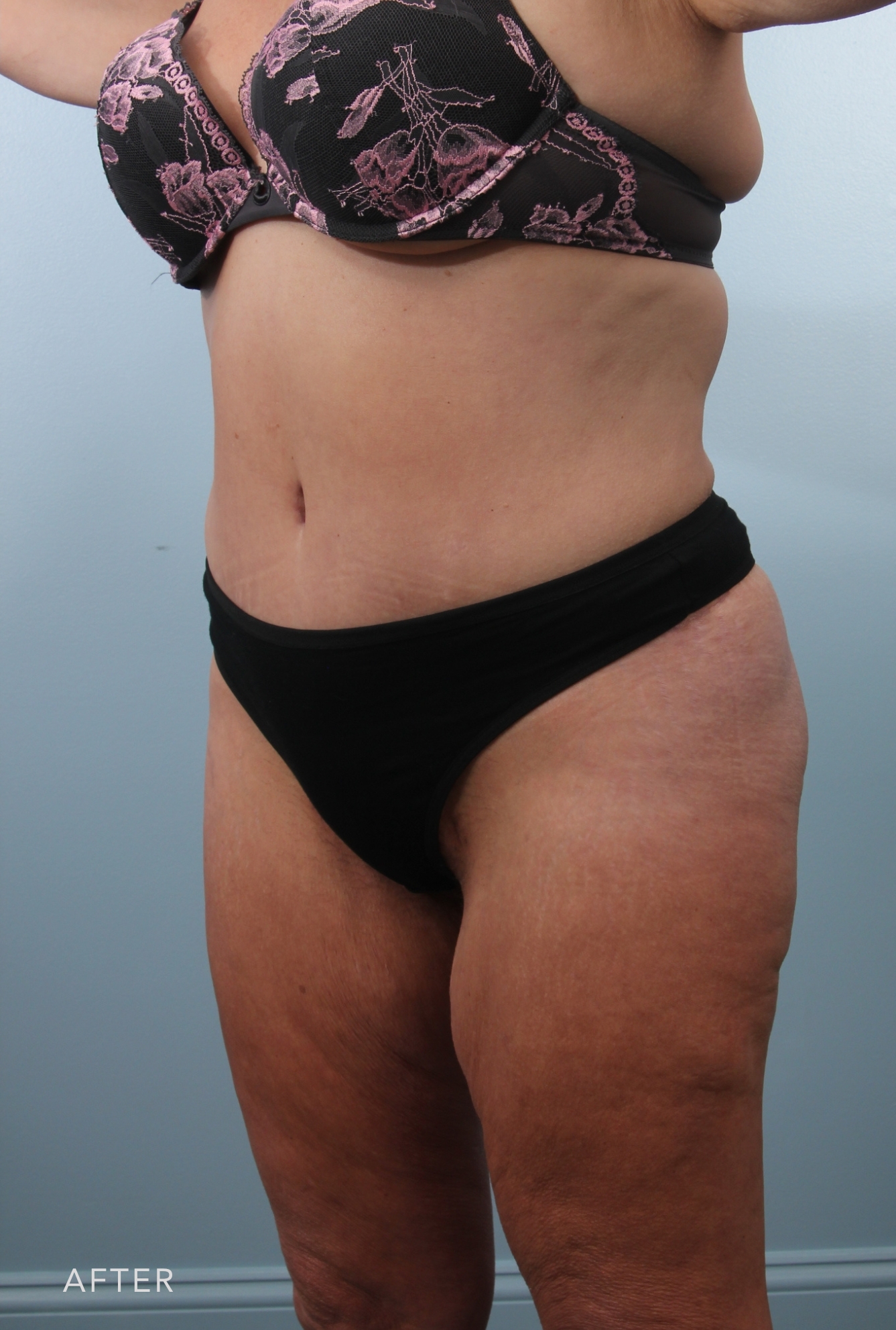 Procedure before and after - after