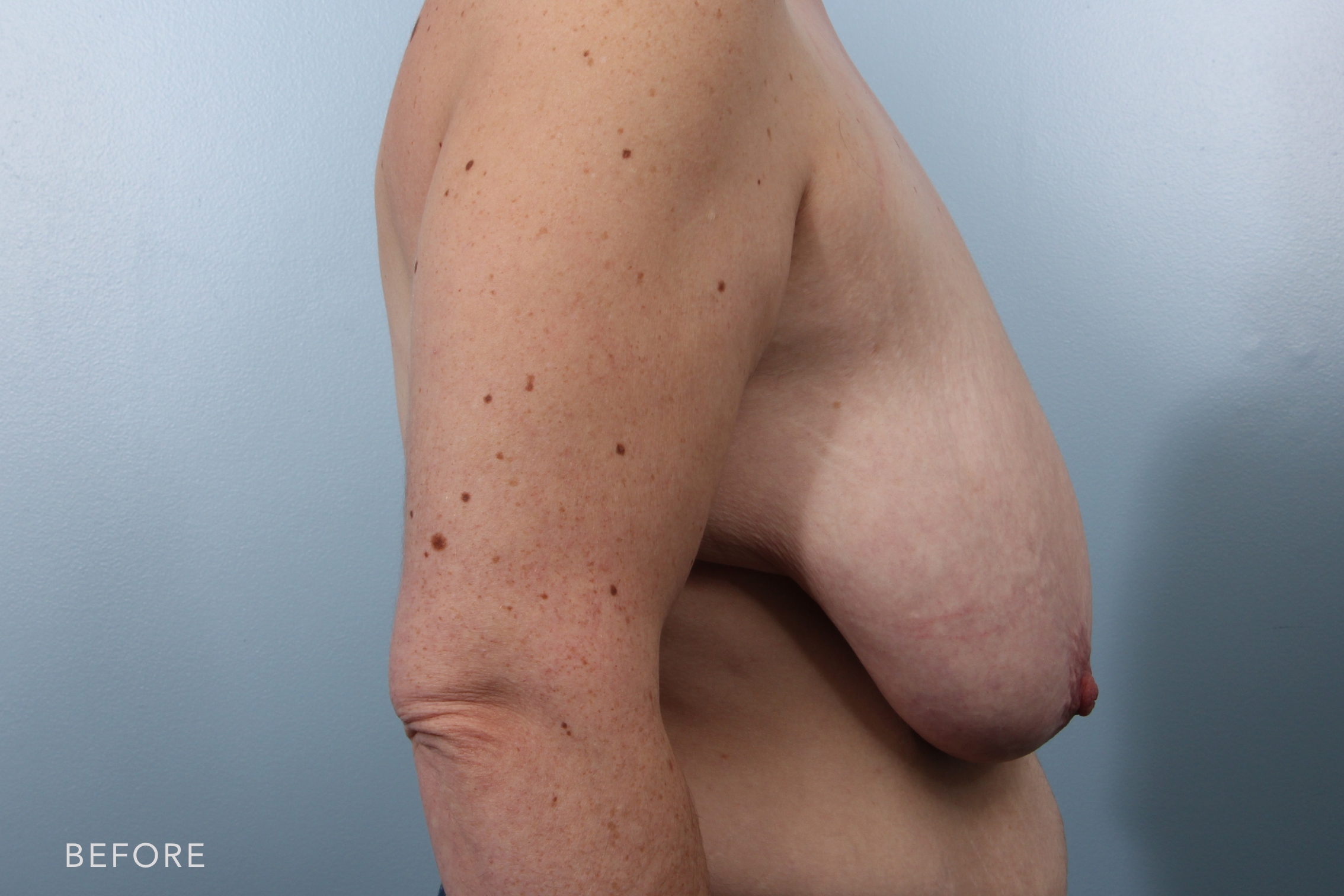 Mommy Makeover before and after - before