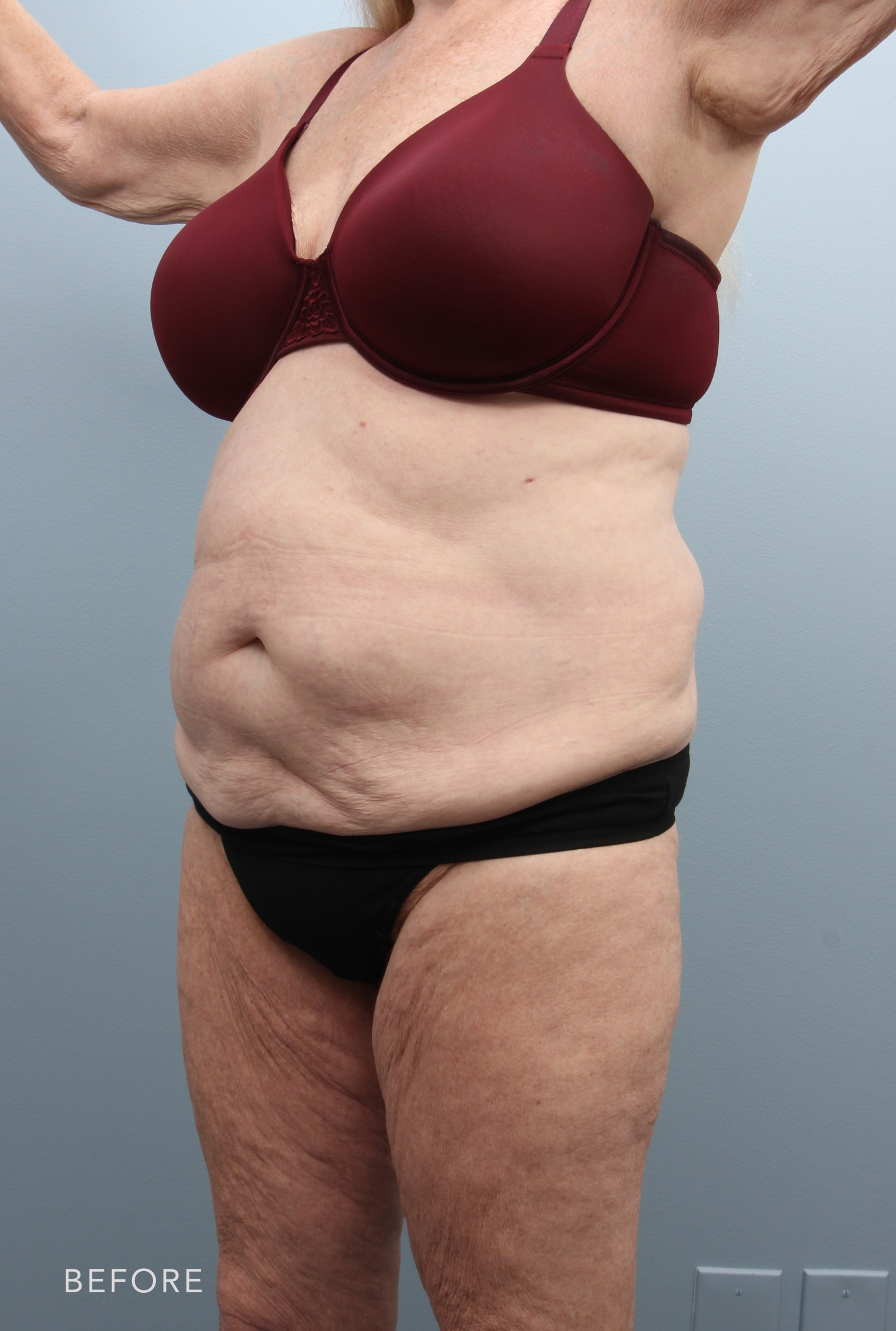 Body Lift before — Dr. Alfredo Lloreda