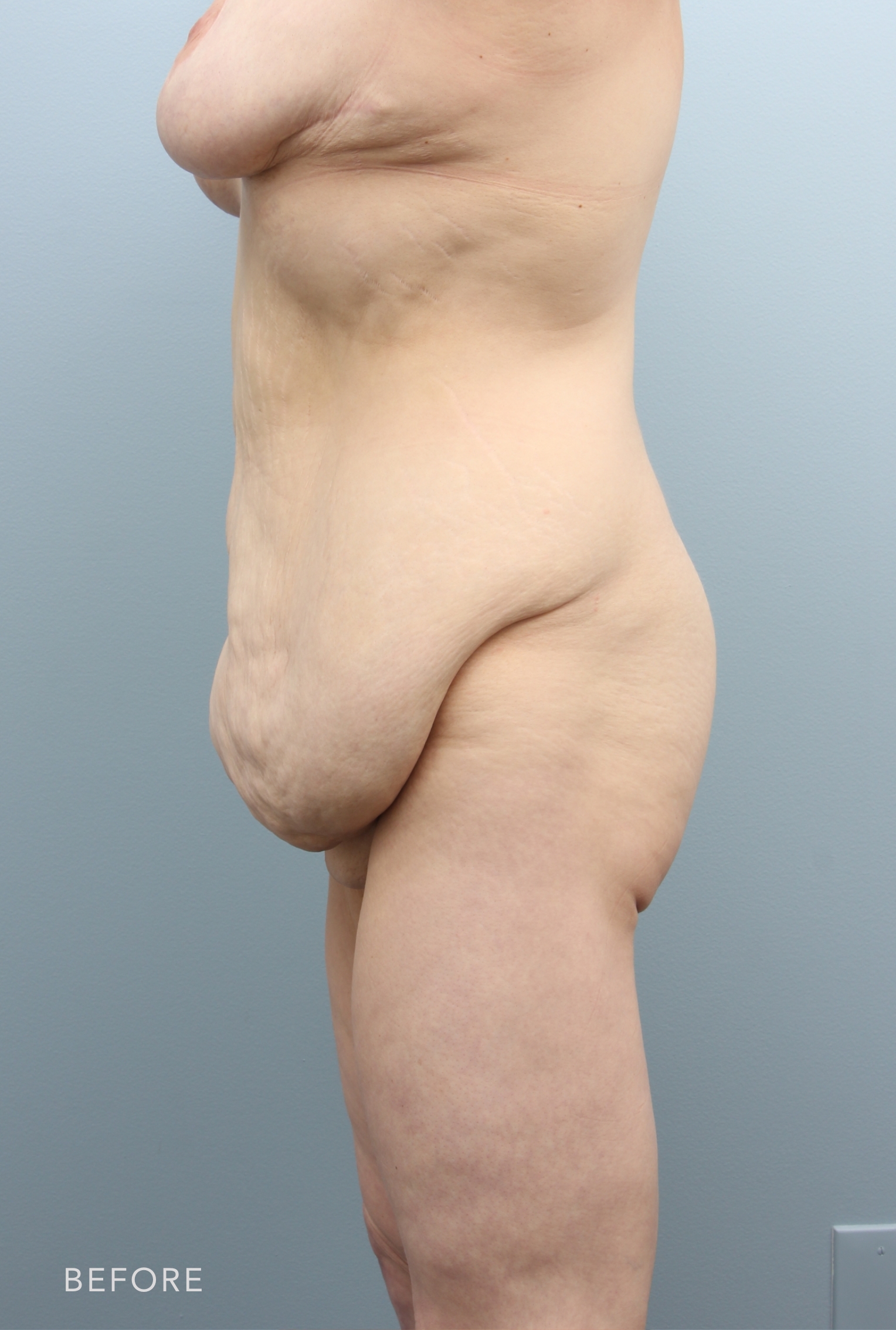 Procedure before and after - before
