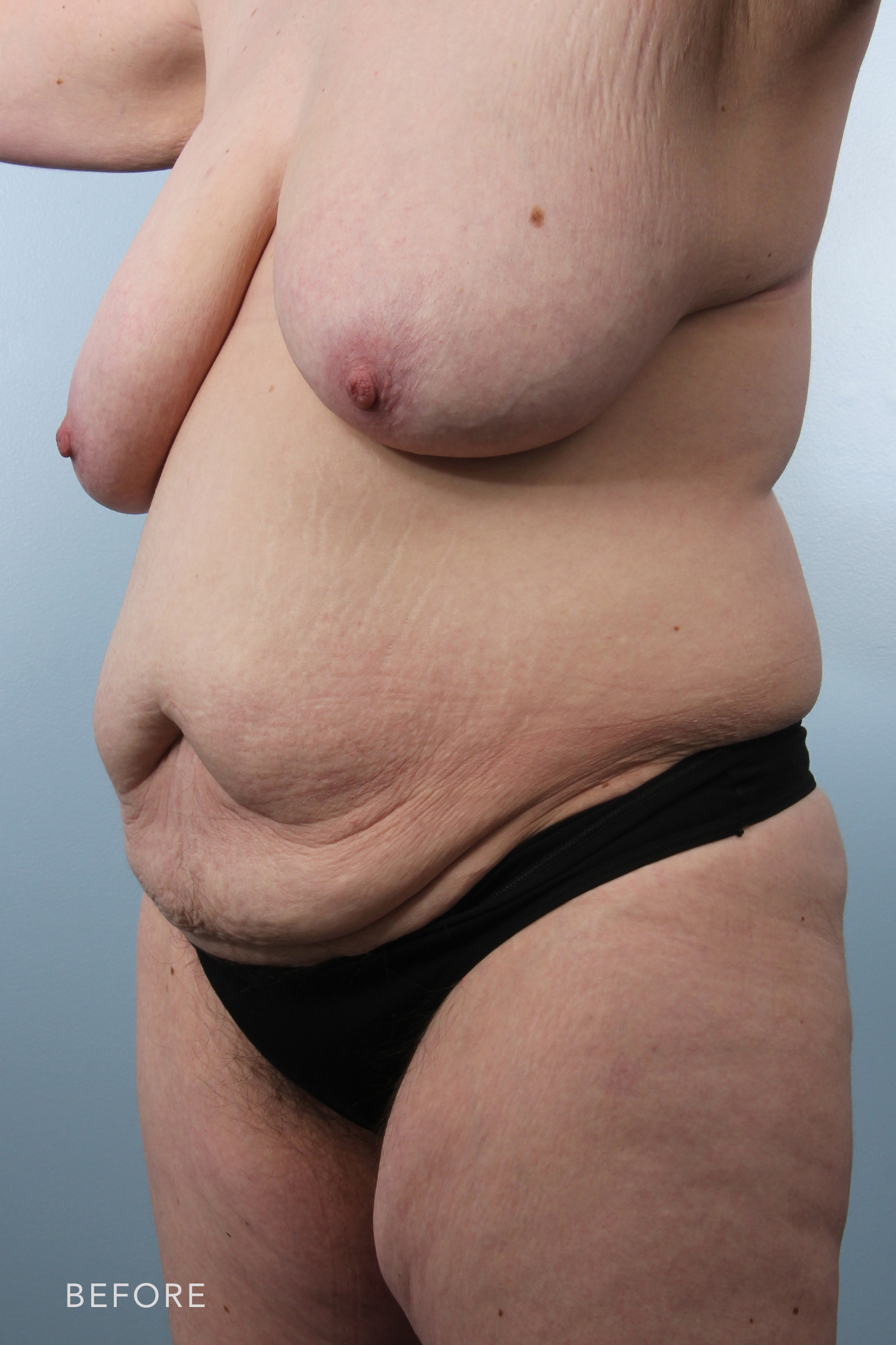 Mommy Makeover by Dr. Alfredo Lloreda — before