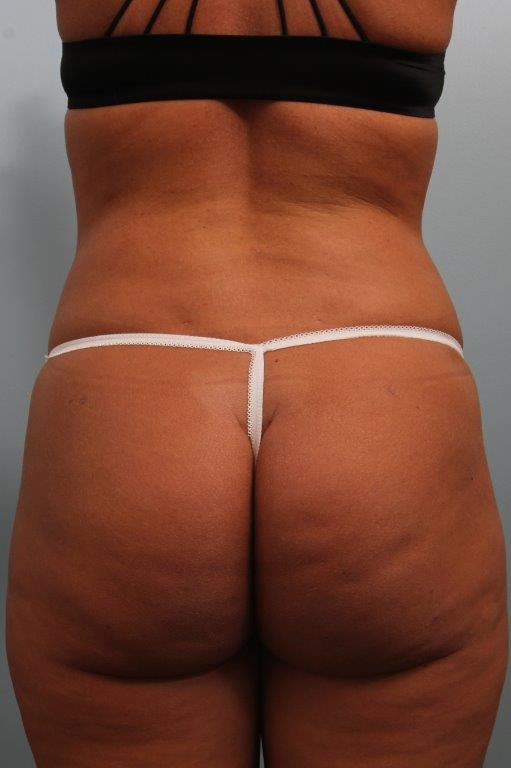 Brazilian Butt Lift by Dr. Alfredo Lloreda — after