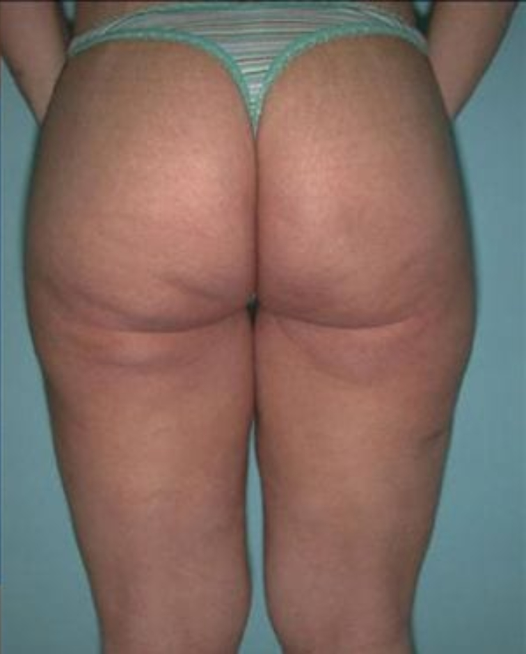 BBL before and after - after