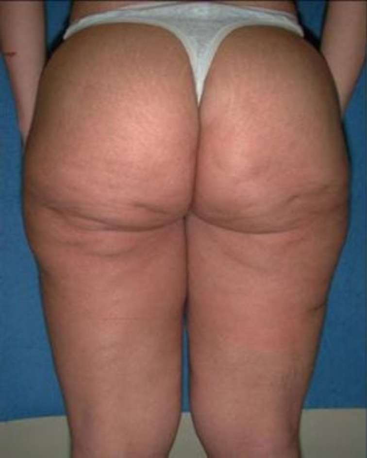 BBL before and after - before