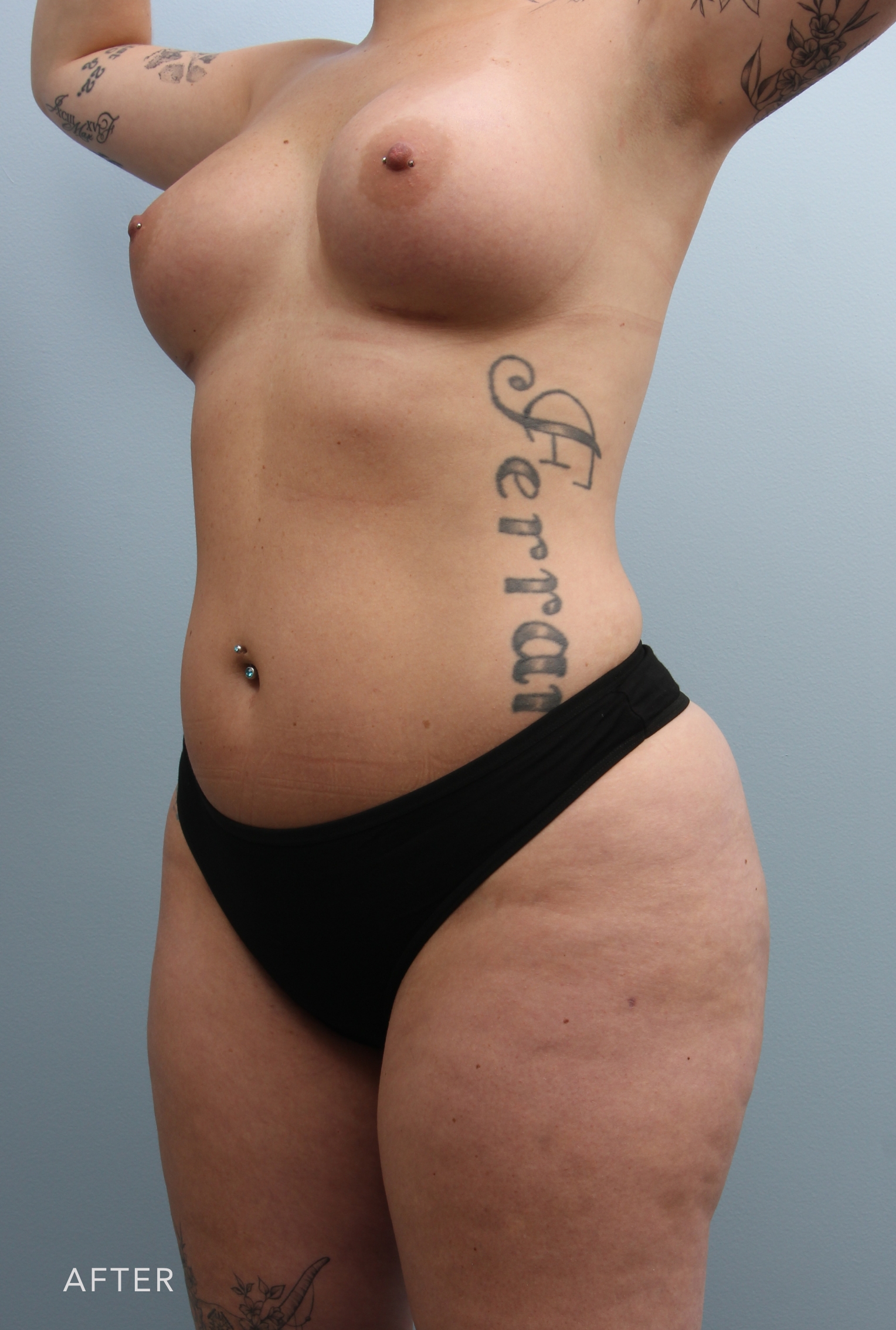 Liposuction after — Dr. Alfredo Lloreda