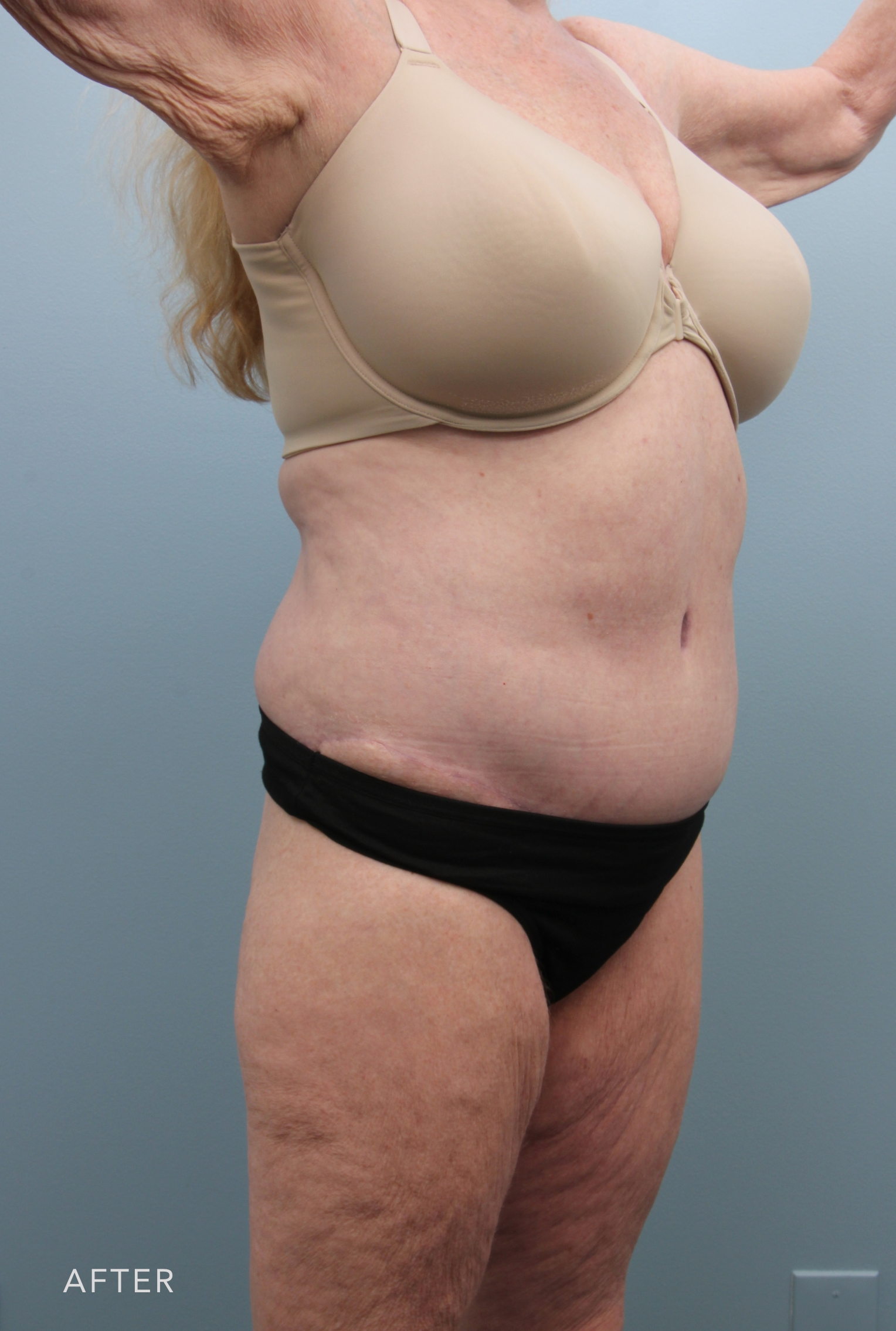 Body Lift after — Dr. Alfredo Lloreda