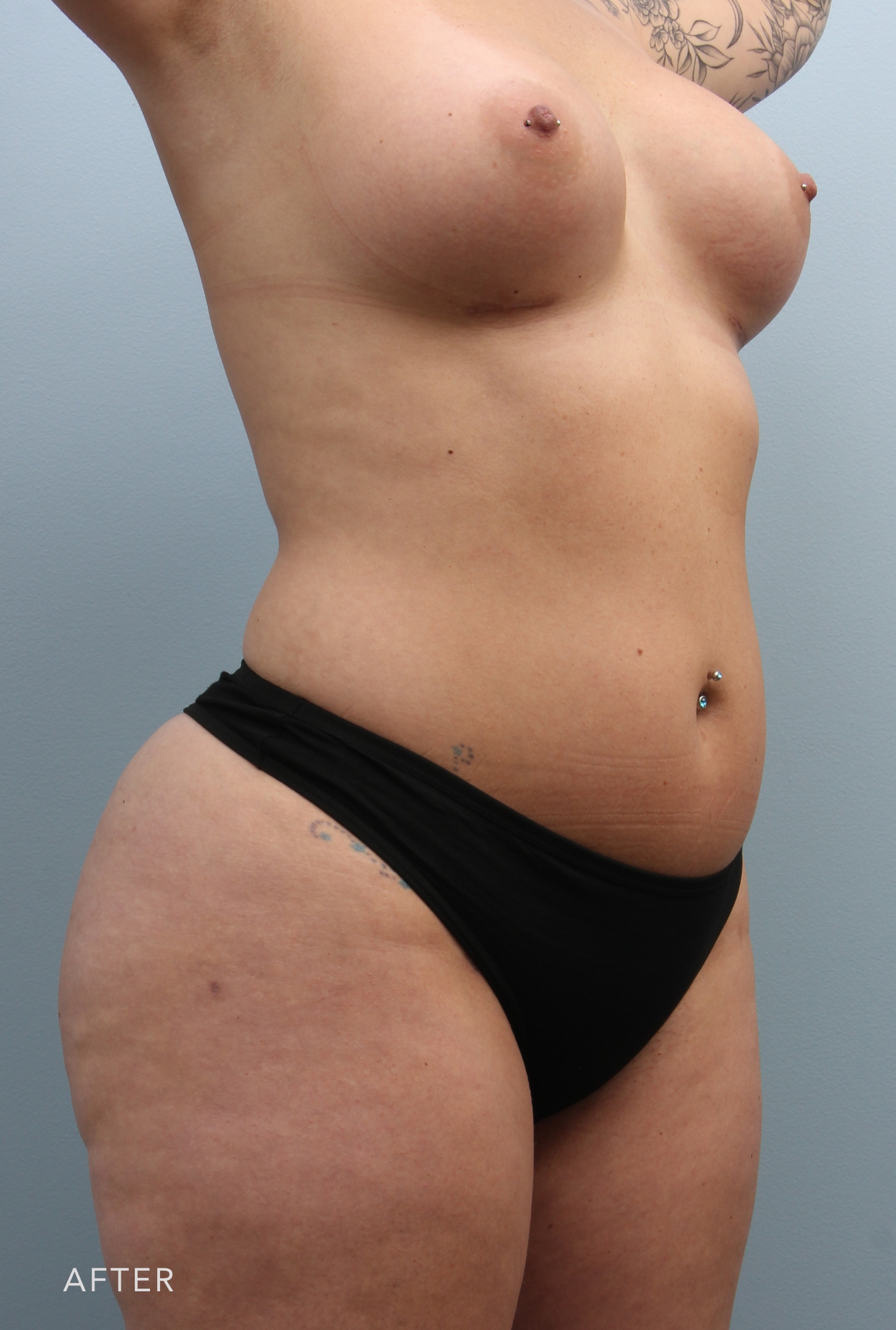 Liposuction after — Dr. Alfredo Lloreda