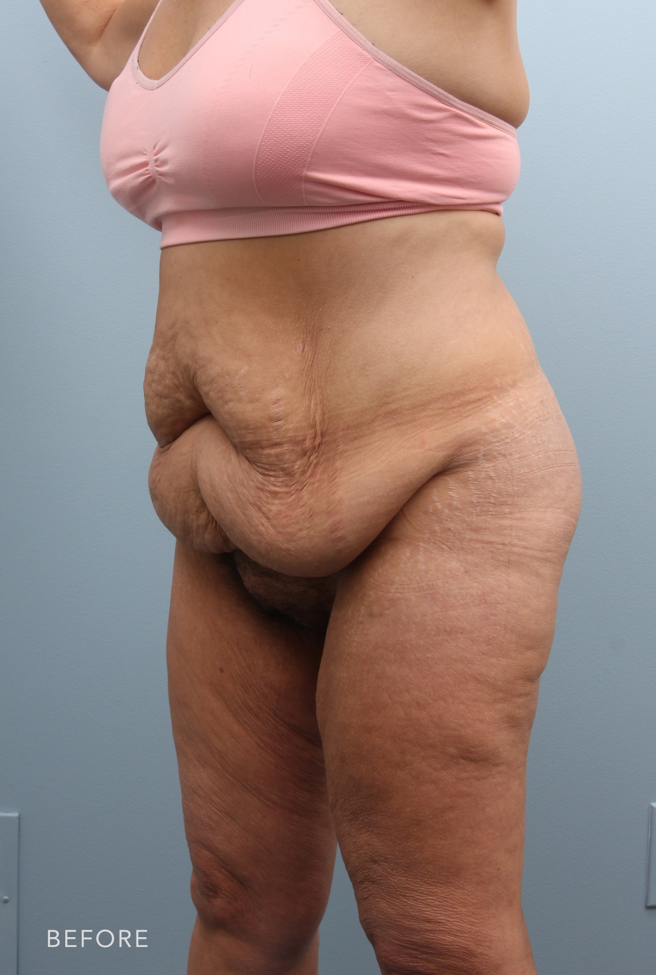Procedure before and after - before