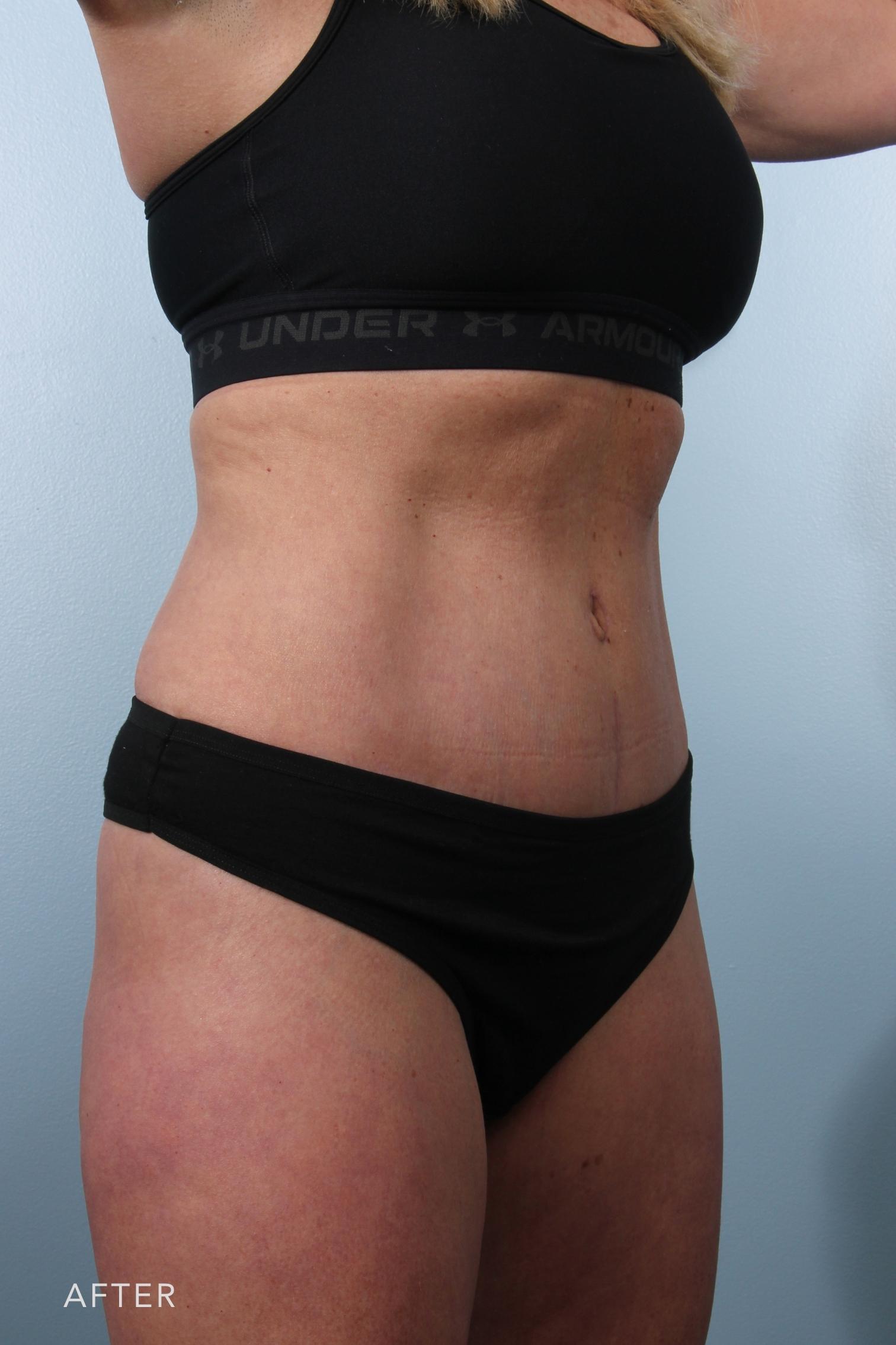Tummy Tuck before and after - after