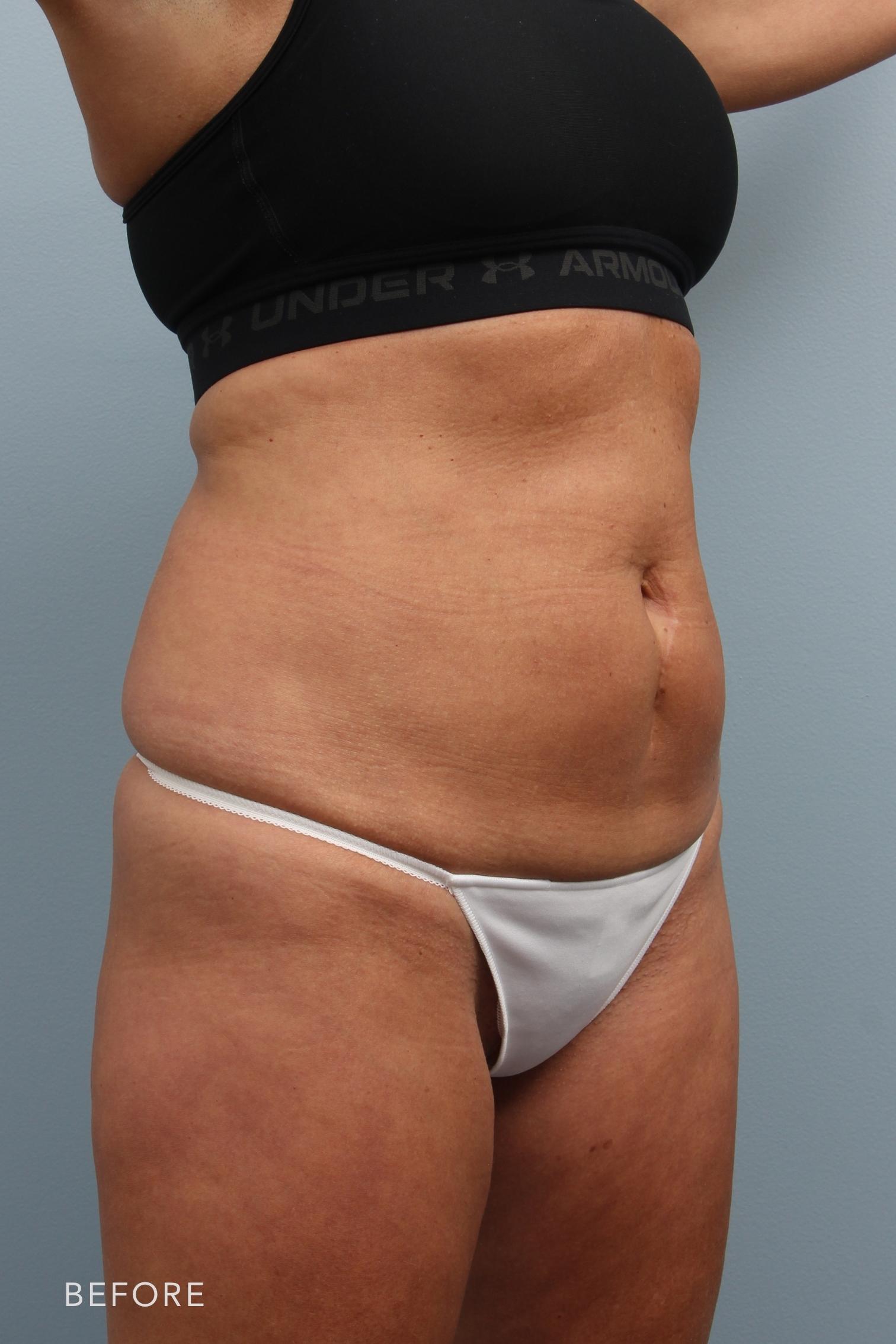 Tummy Tuck before and after - before